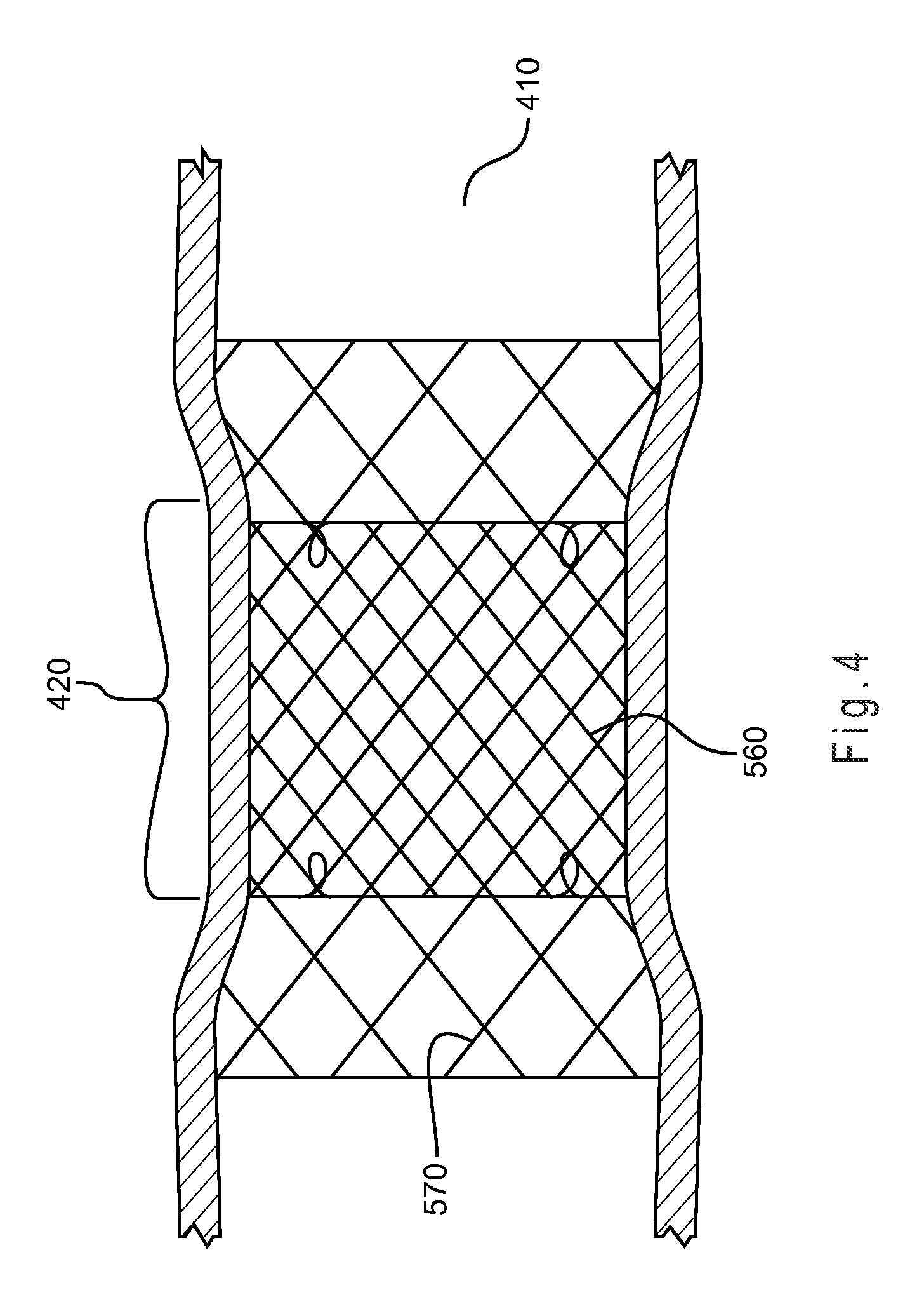 Stent-within-stent arrangements