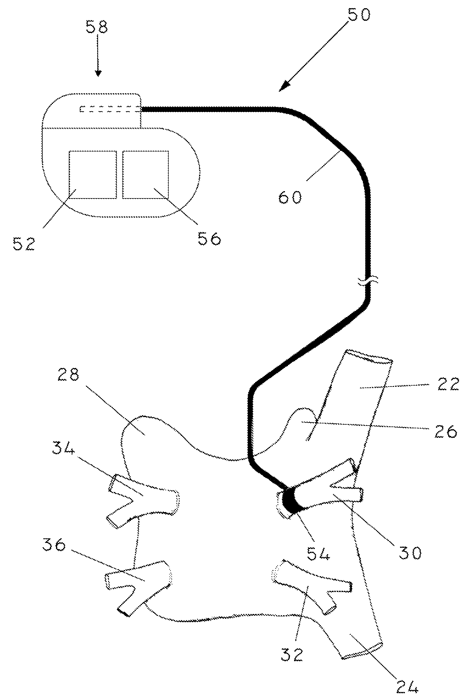 High frequency stimulation for treatment of atrial fibrillation