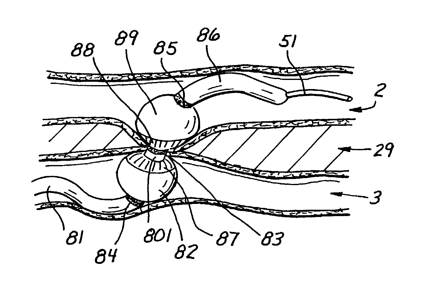 Device, system and method for interstitial transvascular intervention