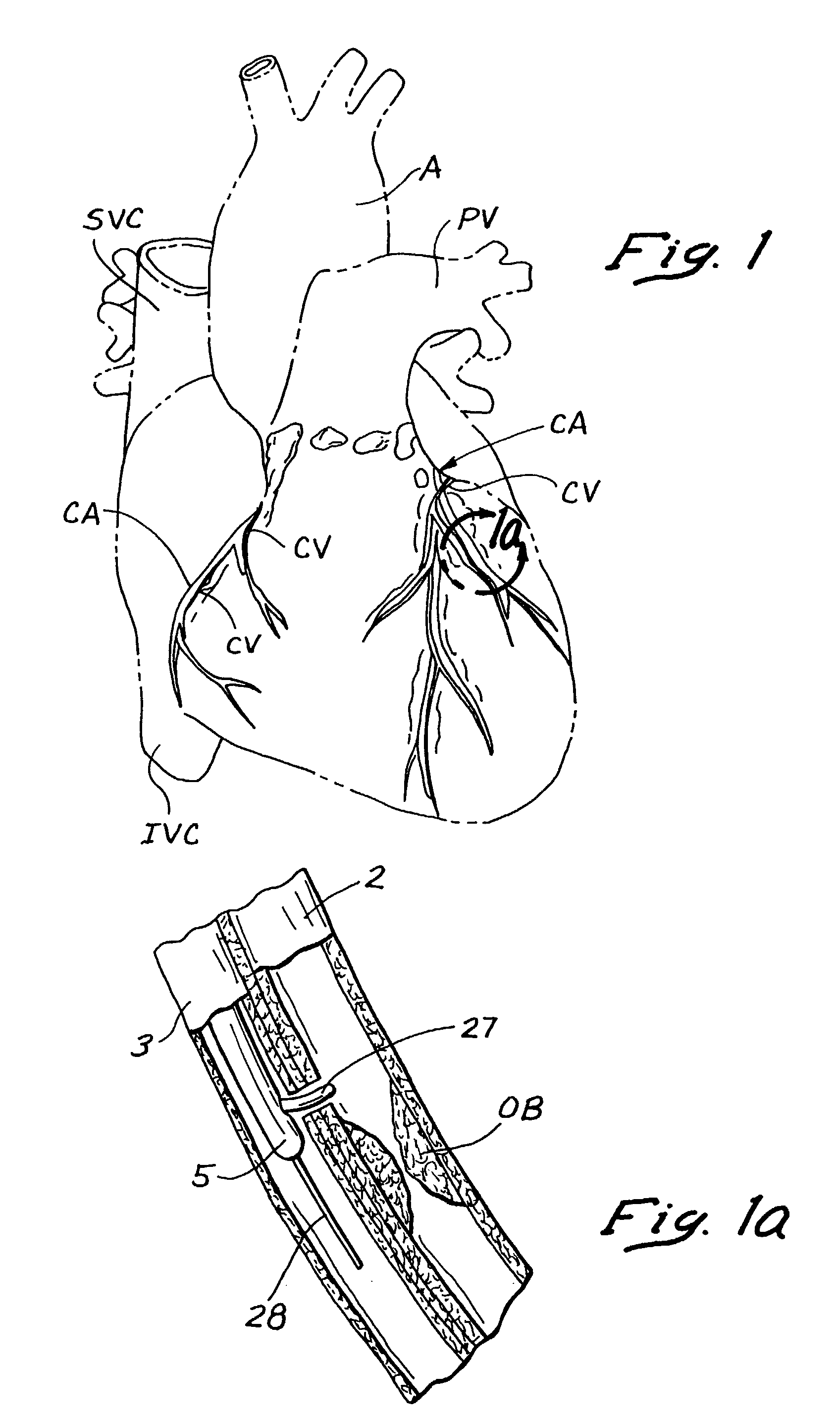 Device, system and method for interstitial transvascular intervention