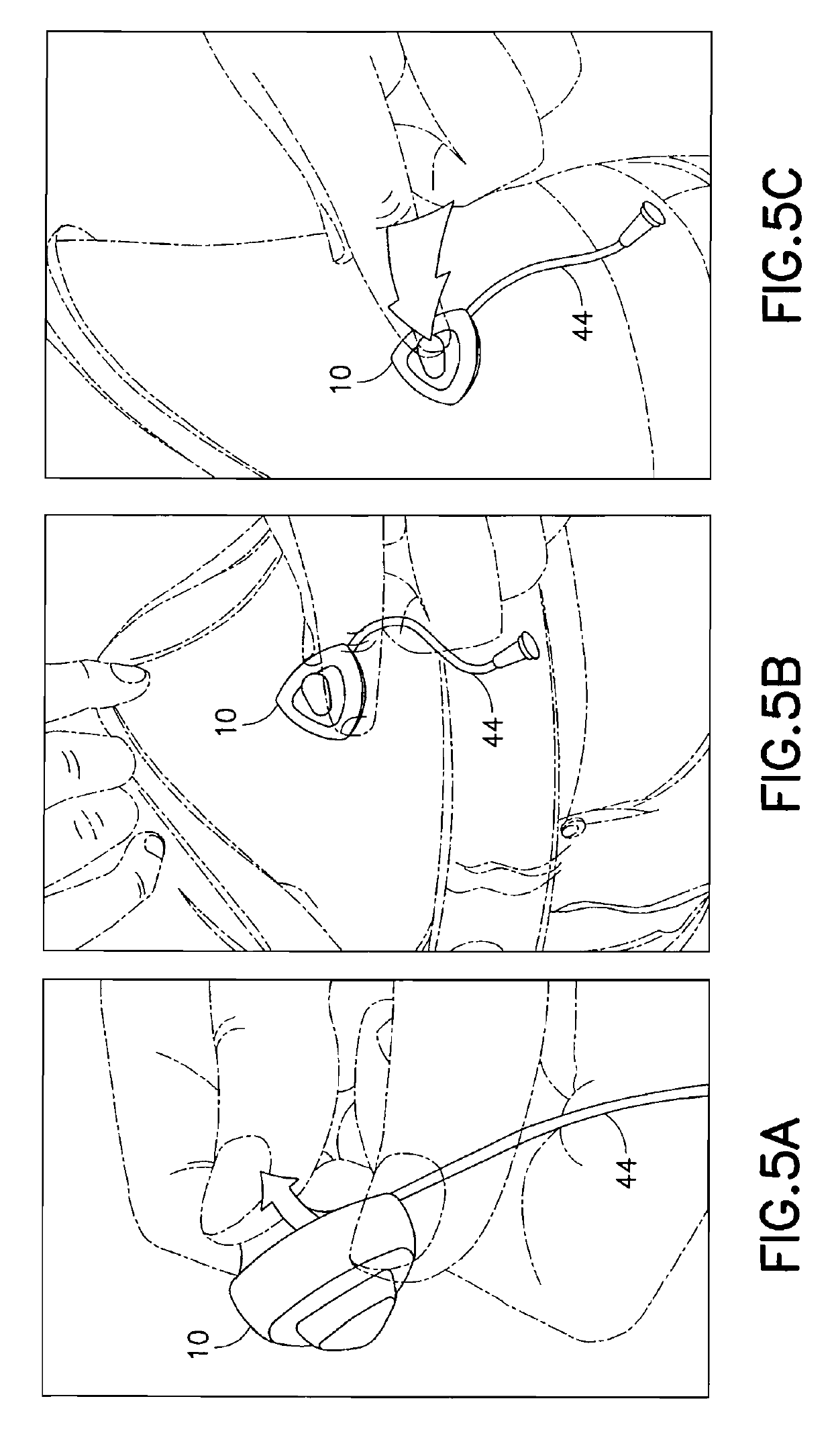 Subcutaneous infusion device