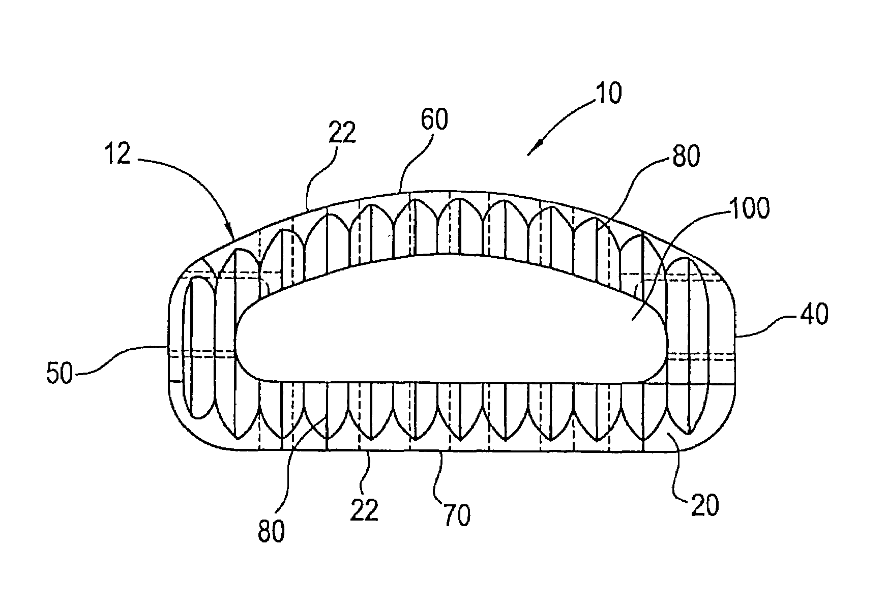 Spinal fusion implant