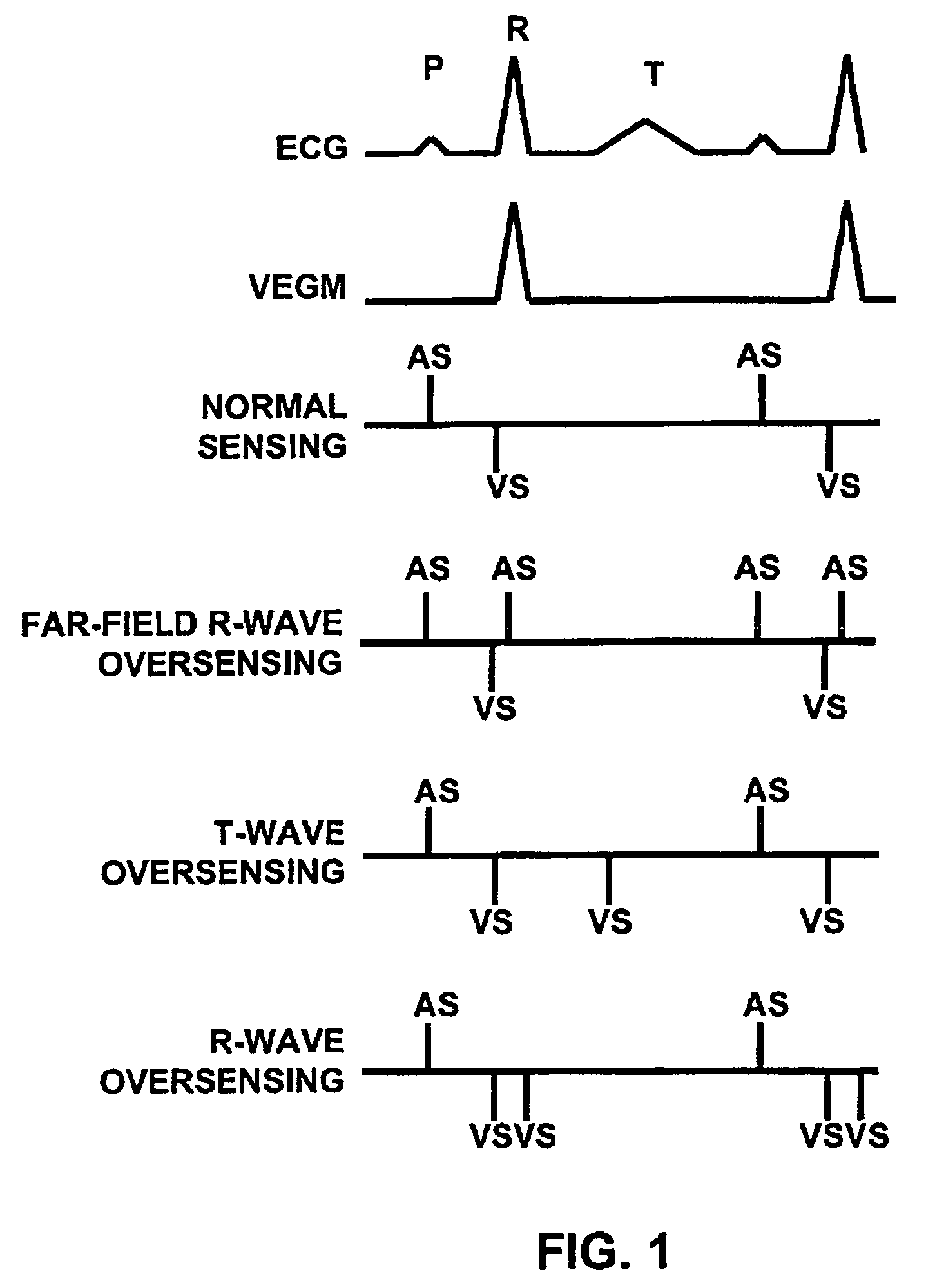 Method and apparatus for identifying oversensing using far-field intracardiac electrograms and marker channels