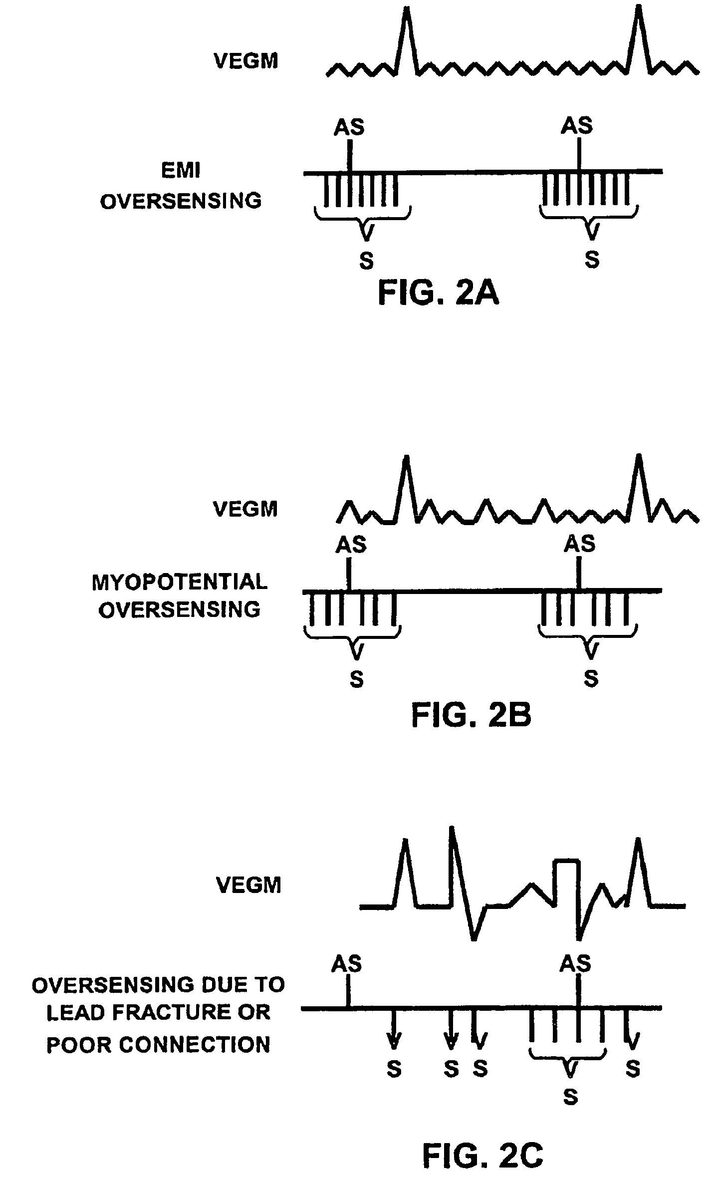 Method and apparatus for identifying oversensing using far-field intracardiac electrograms and marker channels