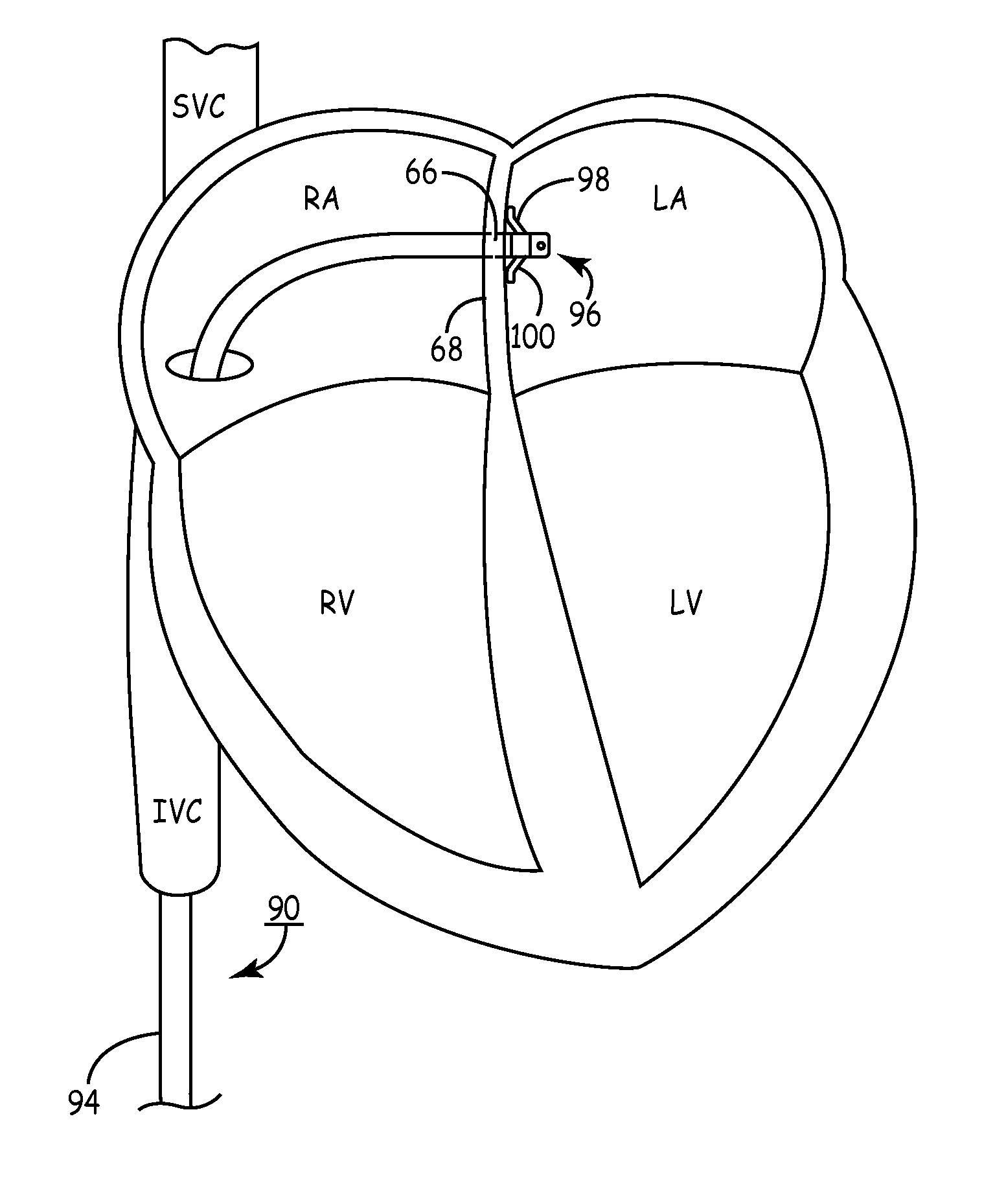 Trans-septal catheter with retention mechanism