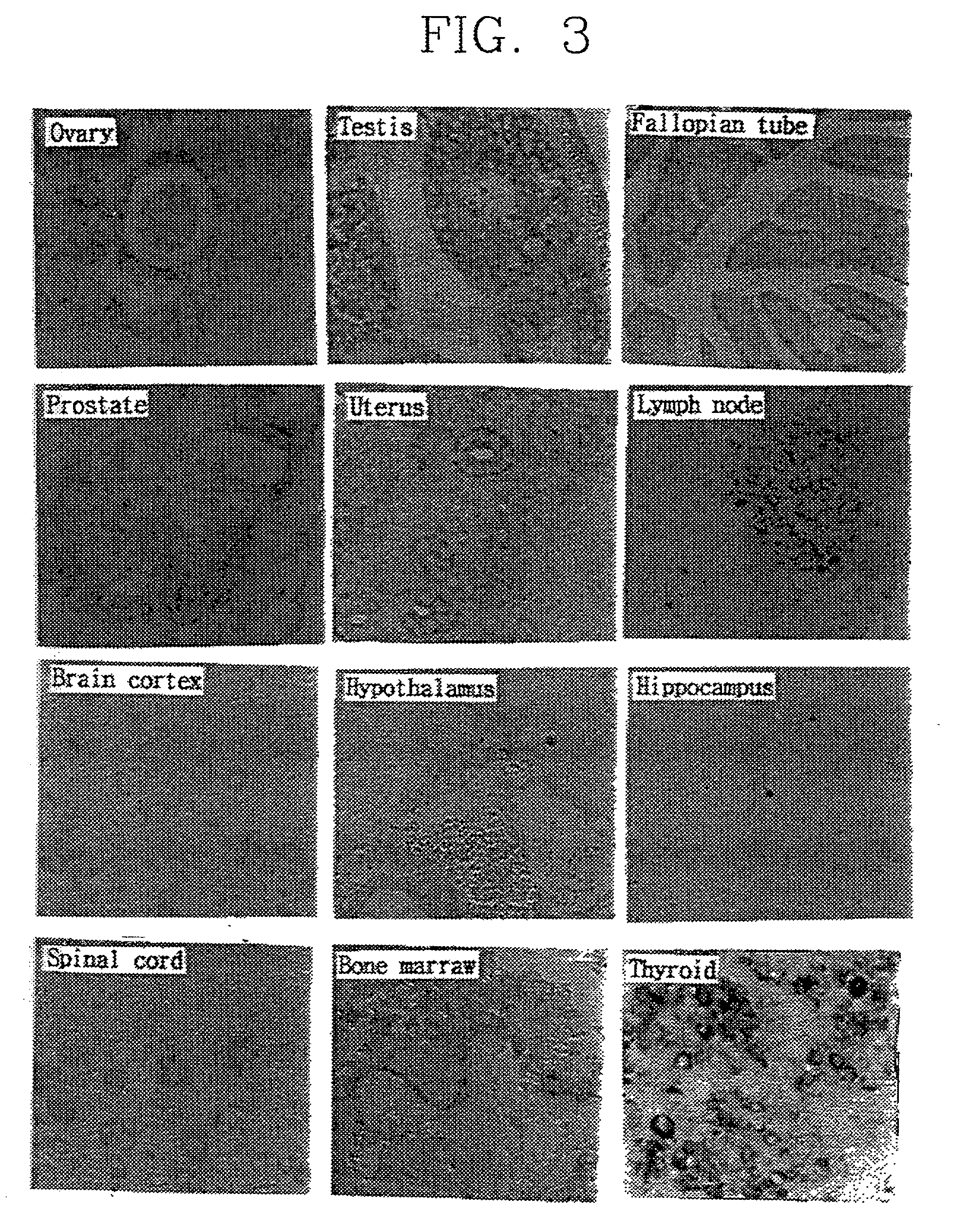 Cancer diagnosis method using cell growth inhibiting and cell differentiation specific SYG972 gene and genomic DNA and promoter thereof