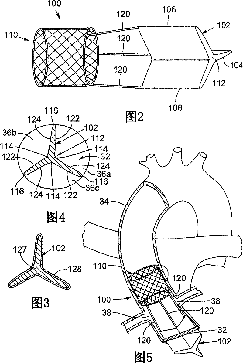 Prosthetic insert for improving heart valve function