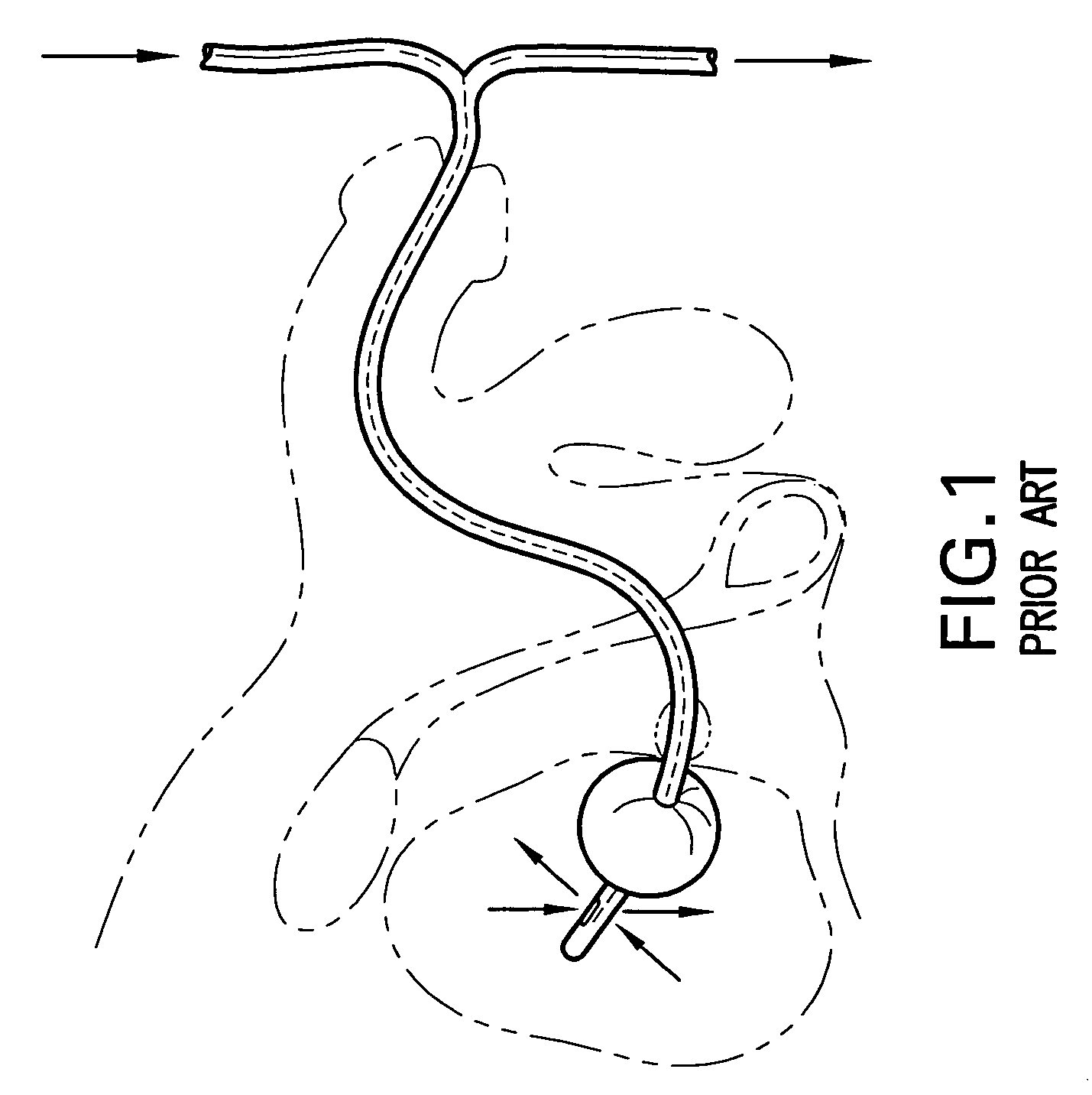 Indwelling urinary catheter