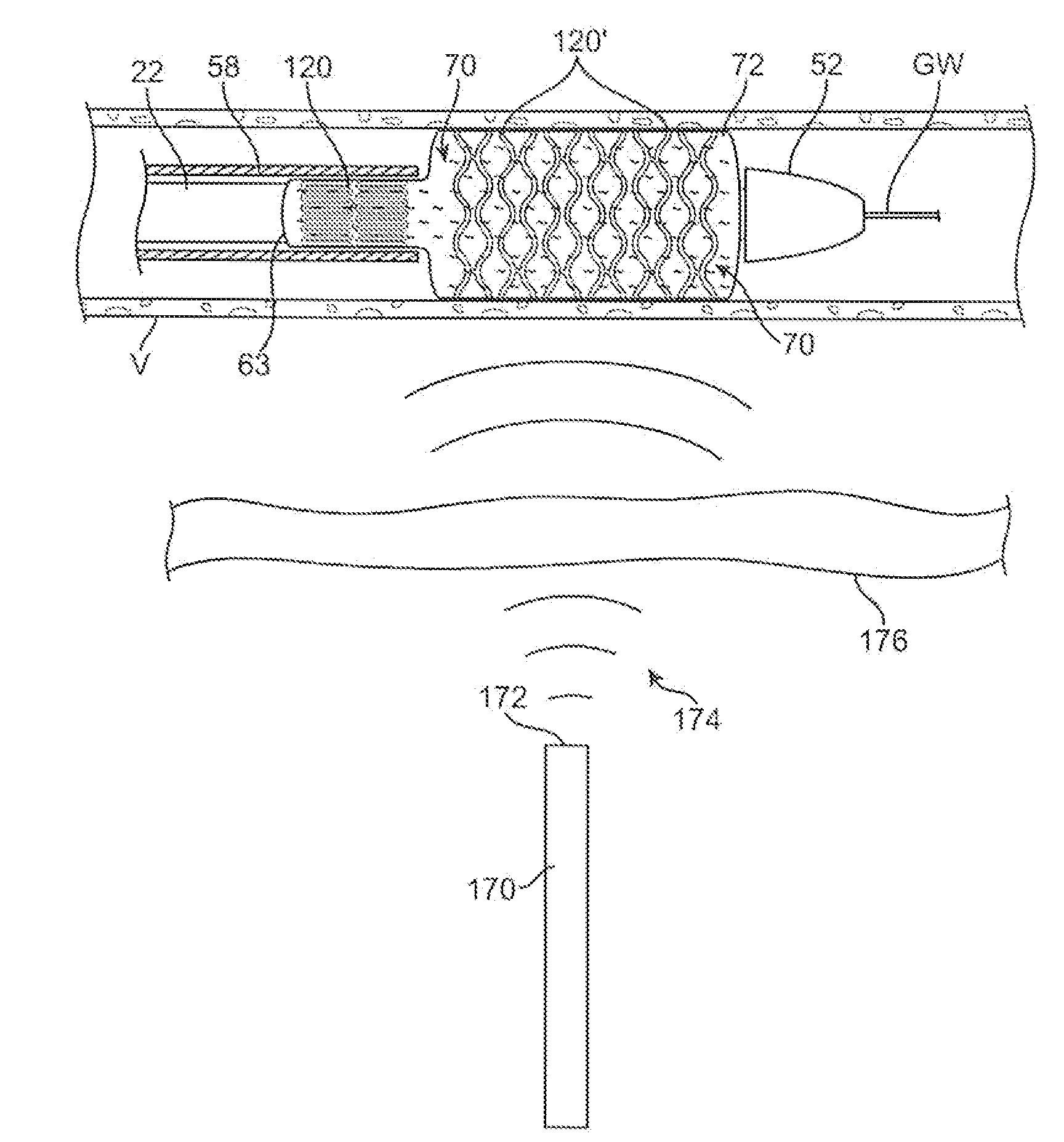 Adjustable-length drug delivery balloon