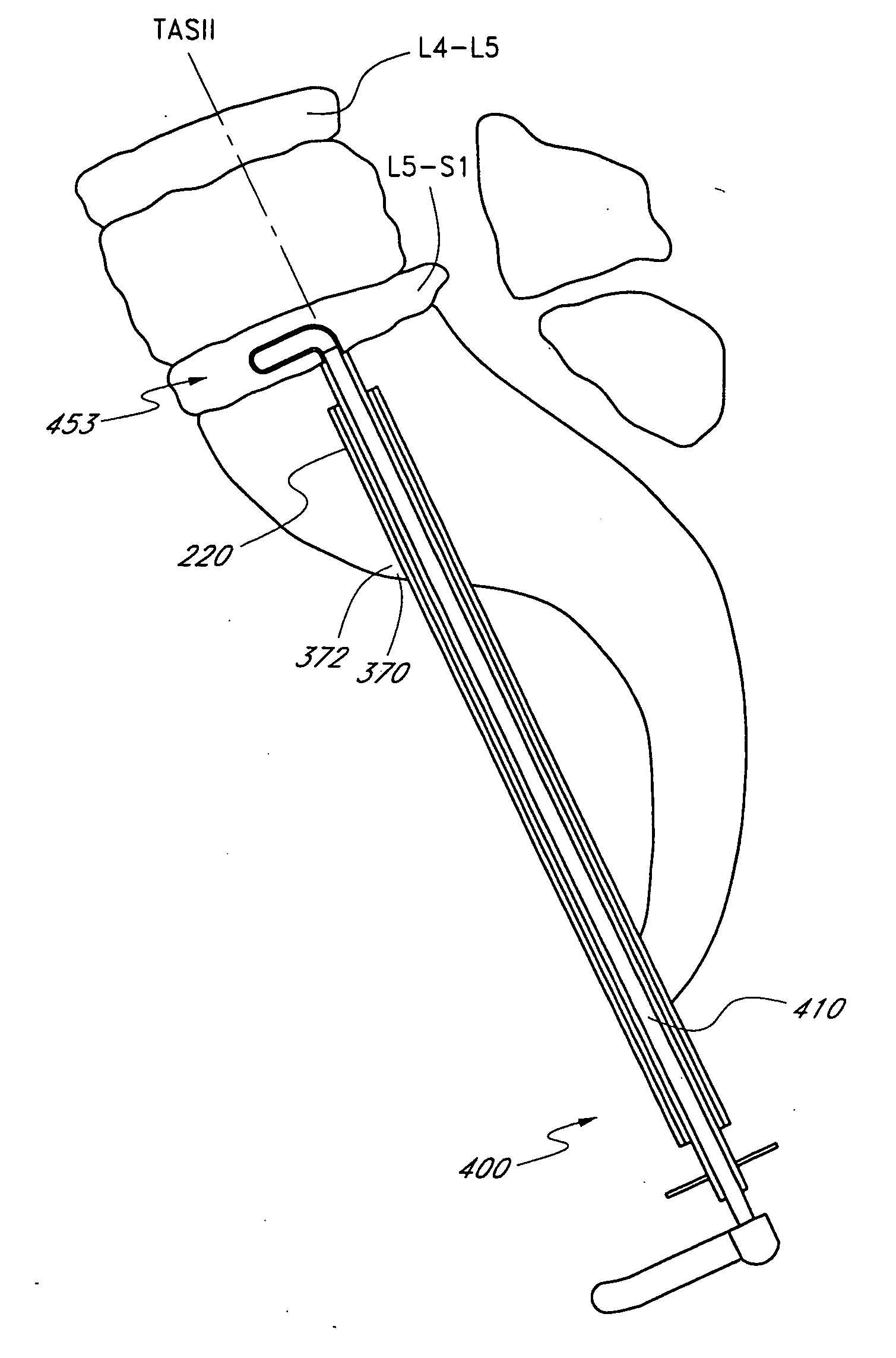 Spinal nucleus extraction tool