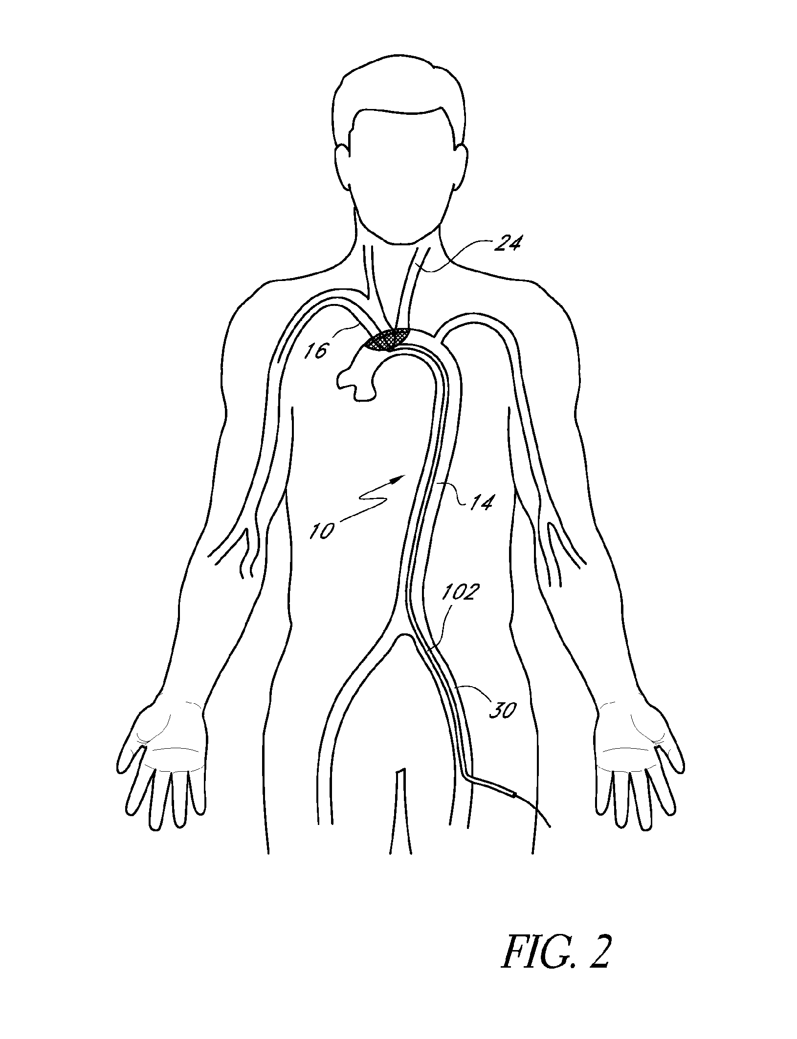 Embolic protection device and method of use