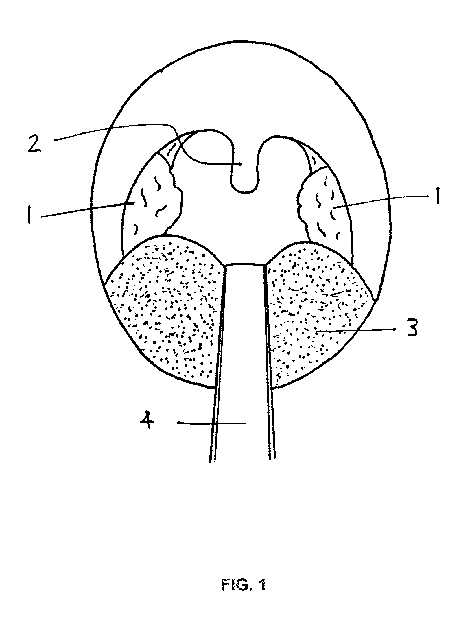 Photothermal treatment of soft tissues