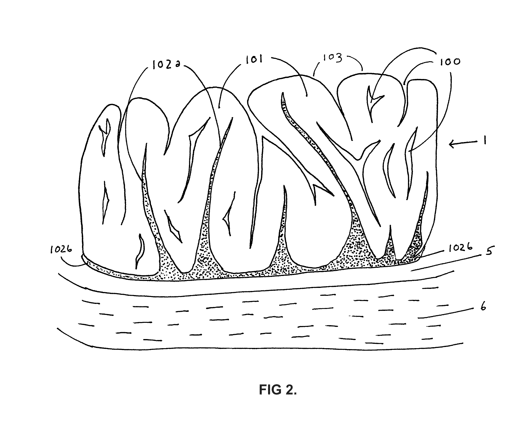 Photothermal treatment of soft tissues