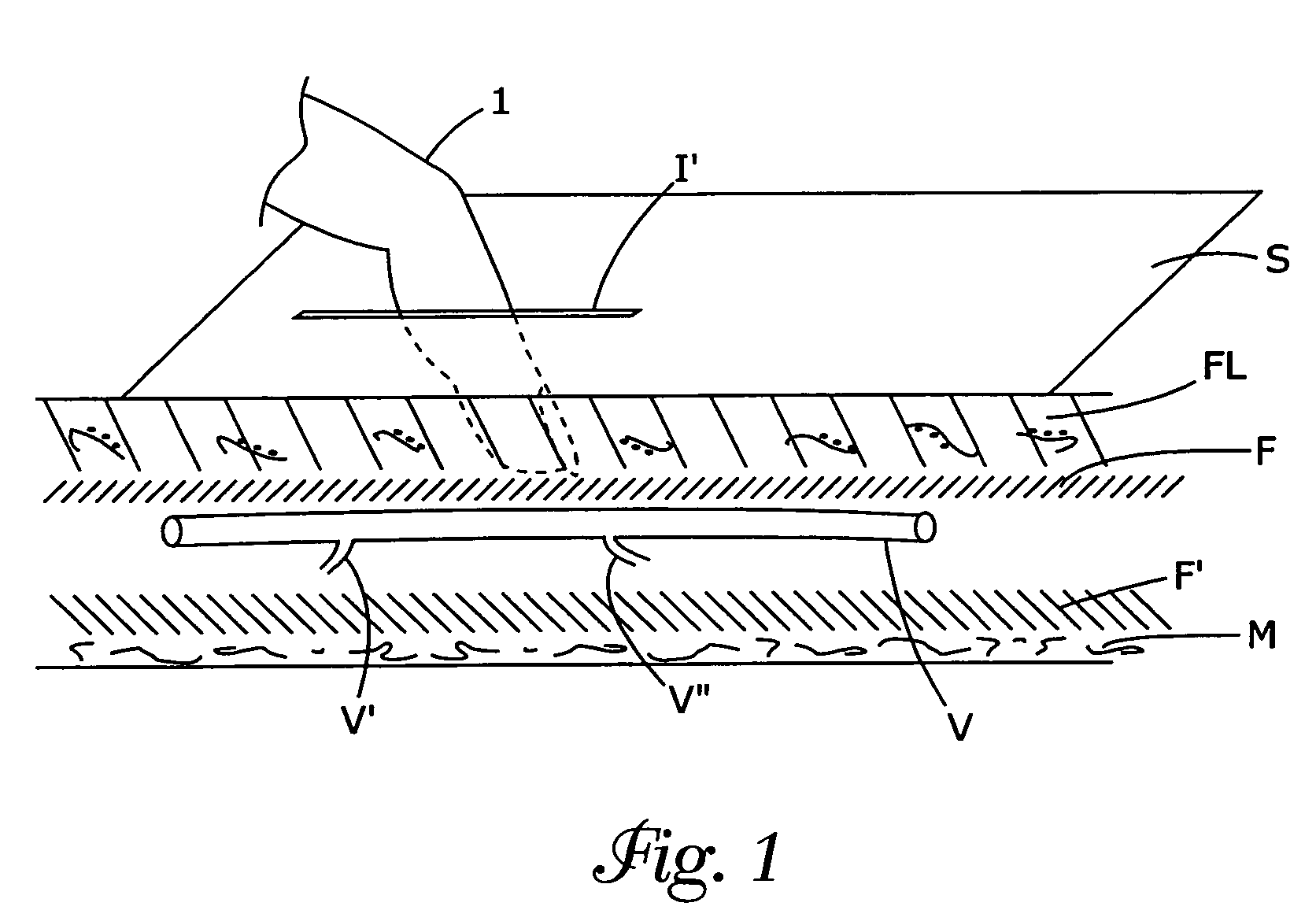 Vein harvesting system and method