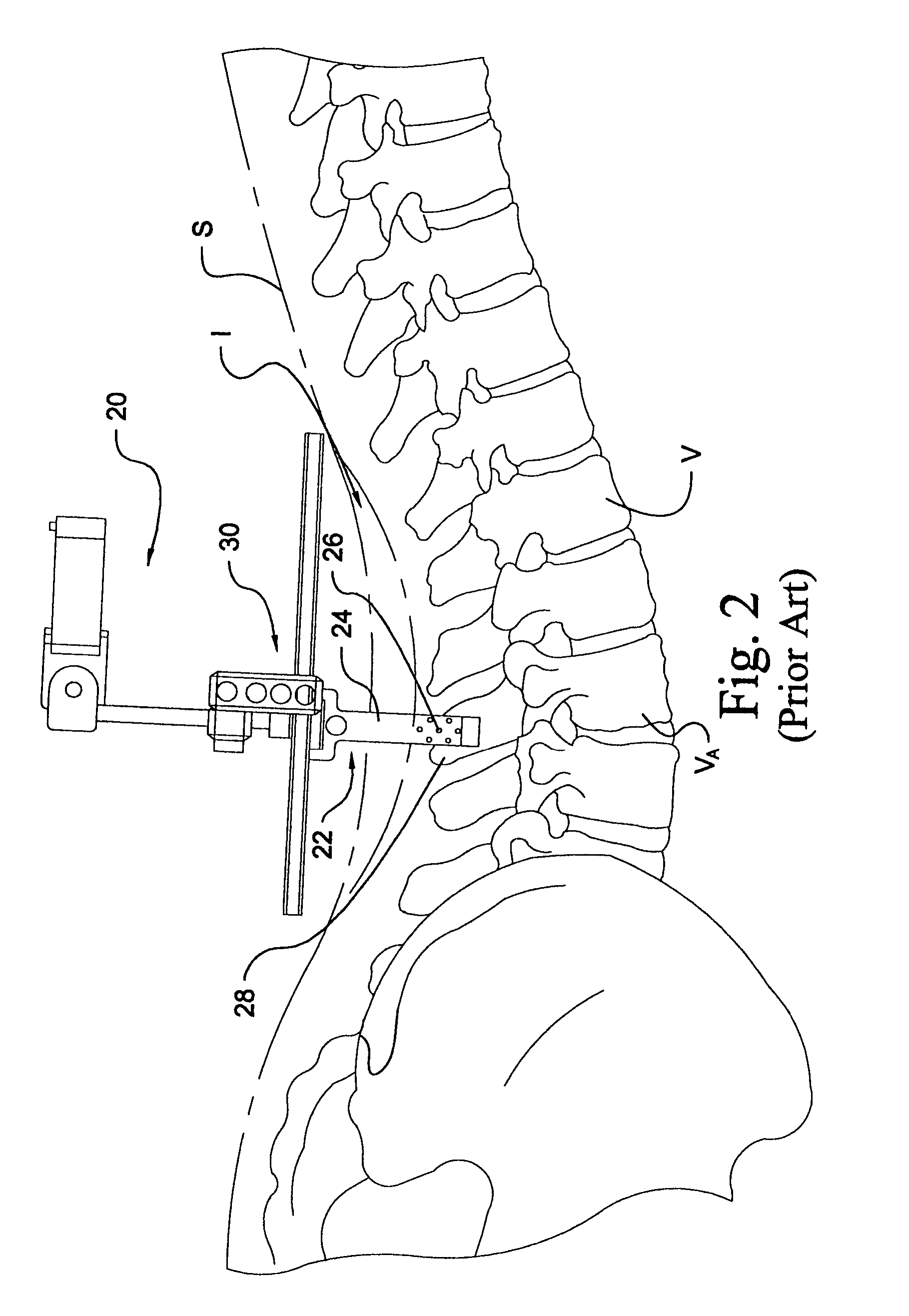 Instrumentation and method for performing image-guided spinal surgery using an anterior surgical approach