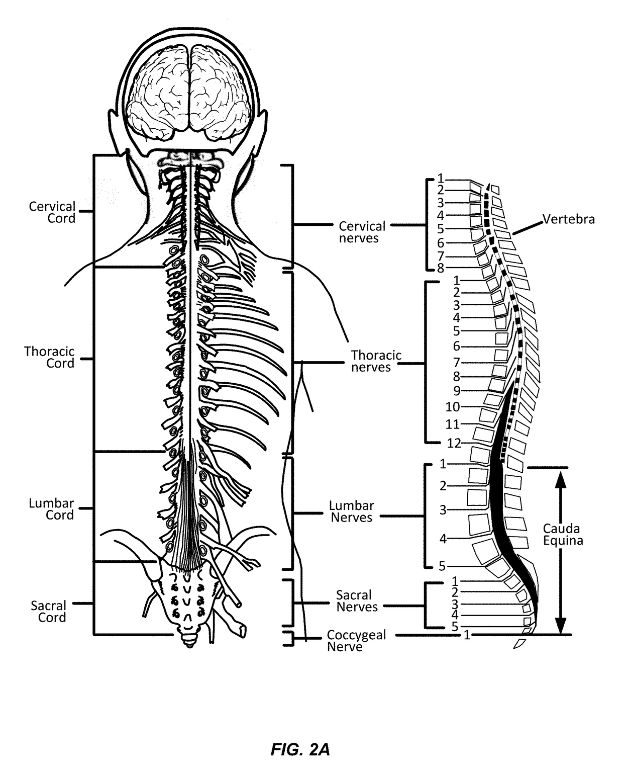 Integrated electromyographic clinician programmer for use with an implantable neurostimulator