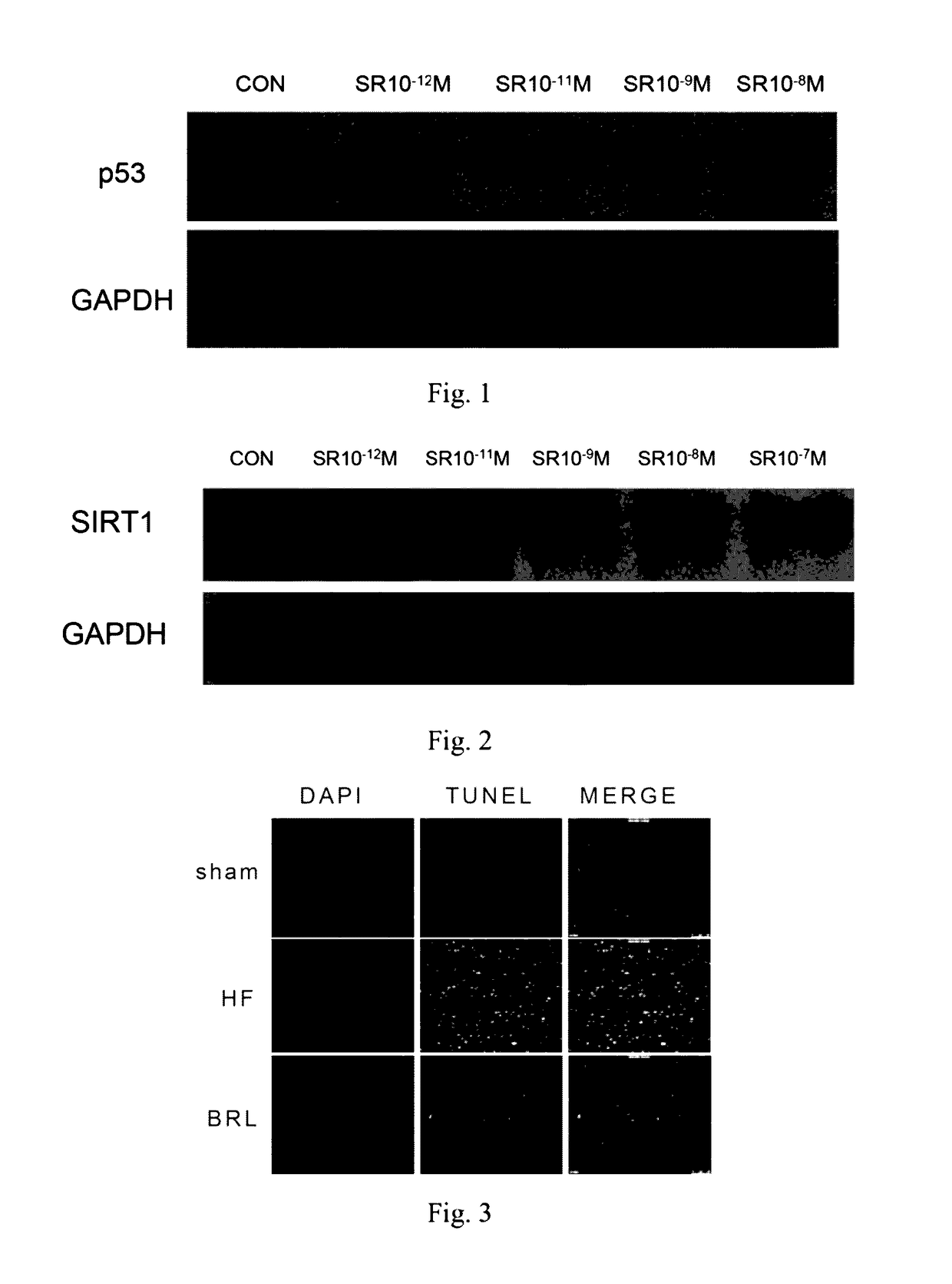 Use of adrenergic beta-E-receptor blockers in cancer treatment