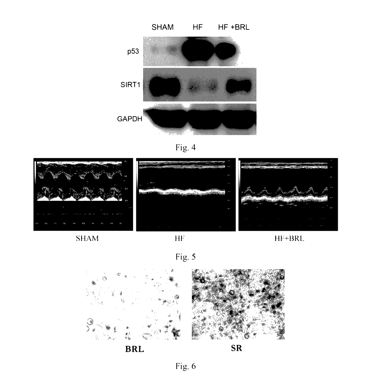 Use of adrenergic beta-E-receptor blockers in cancer treatment