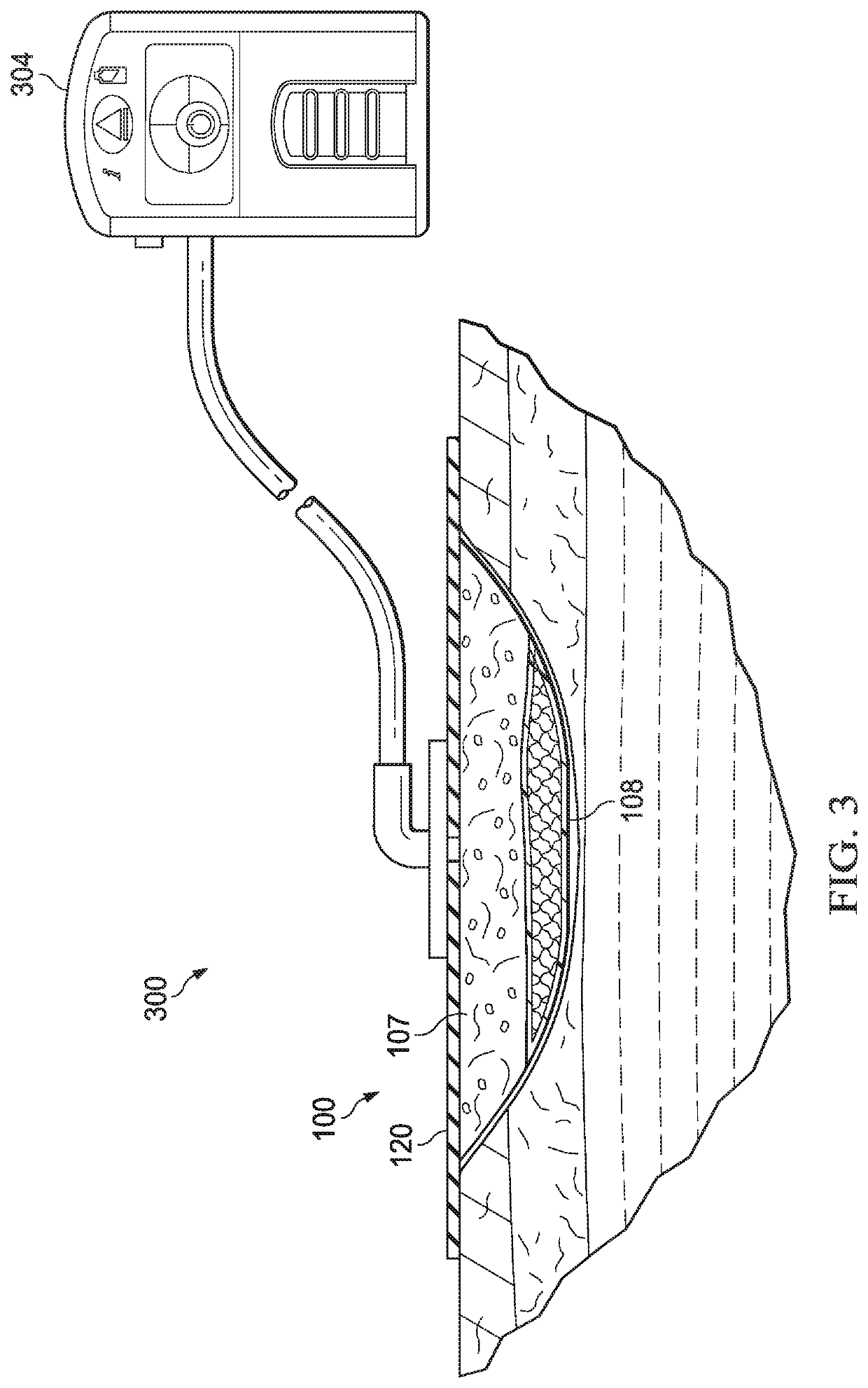 Dressings for filtering wound fluids