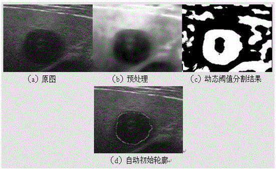 A Method of Obtaining Initial Contour in Ultrasound Image Segmentation Based on Active Contour Model