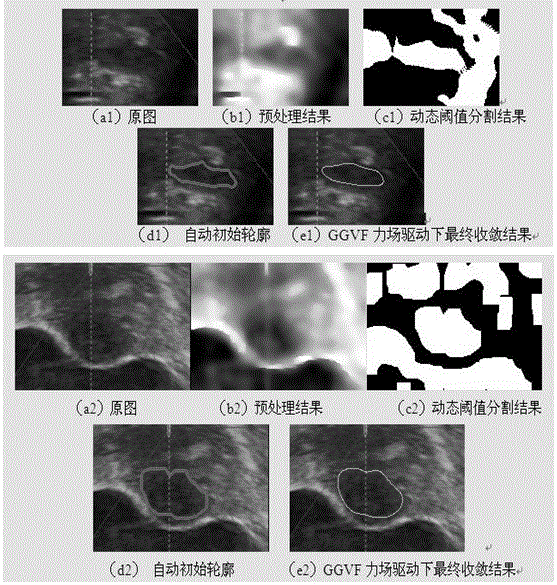 A Method of Obtaining Initial Contour in Ultrasound Image Segmentation Based on Active Contour Model