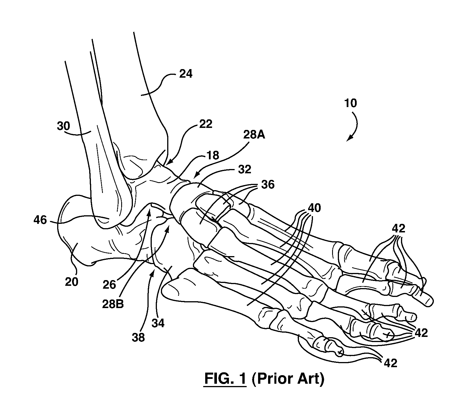 Foot stabilizer socks and stabilizer pads therefor