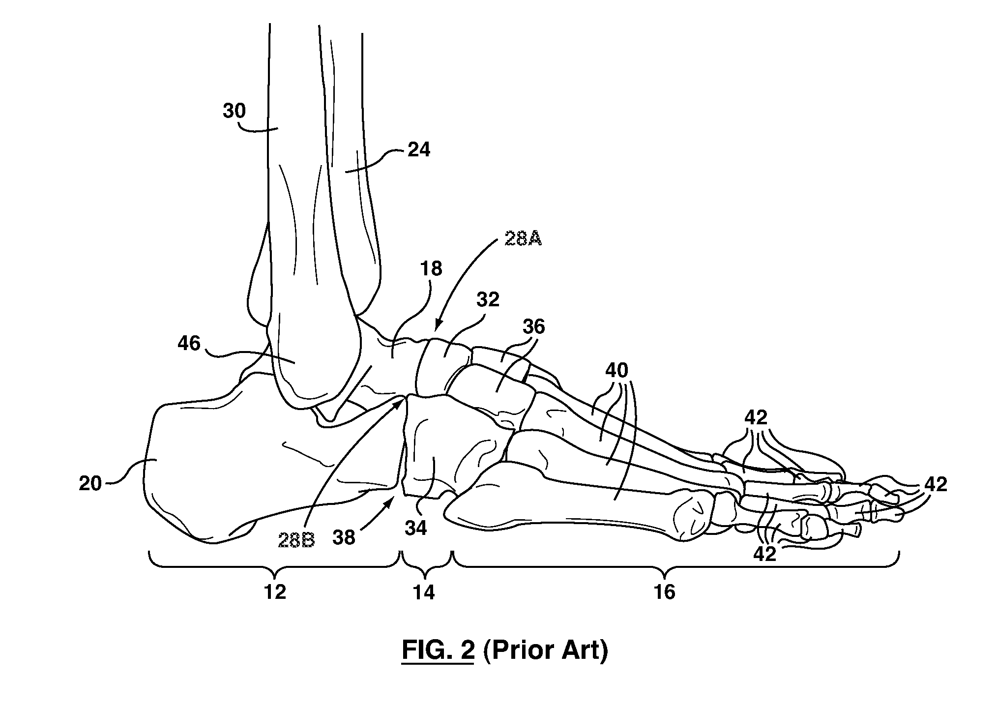 Foot stabilizer socks and stabilizer pads therefor