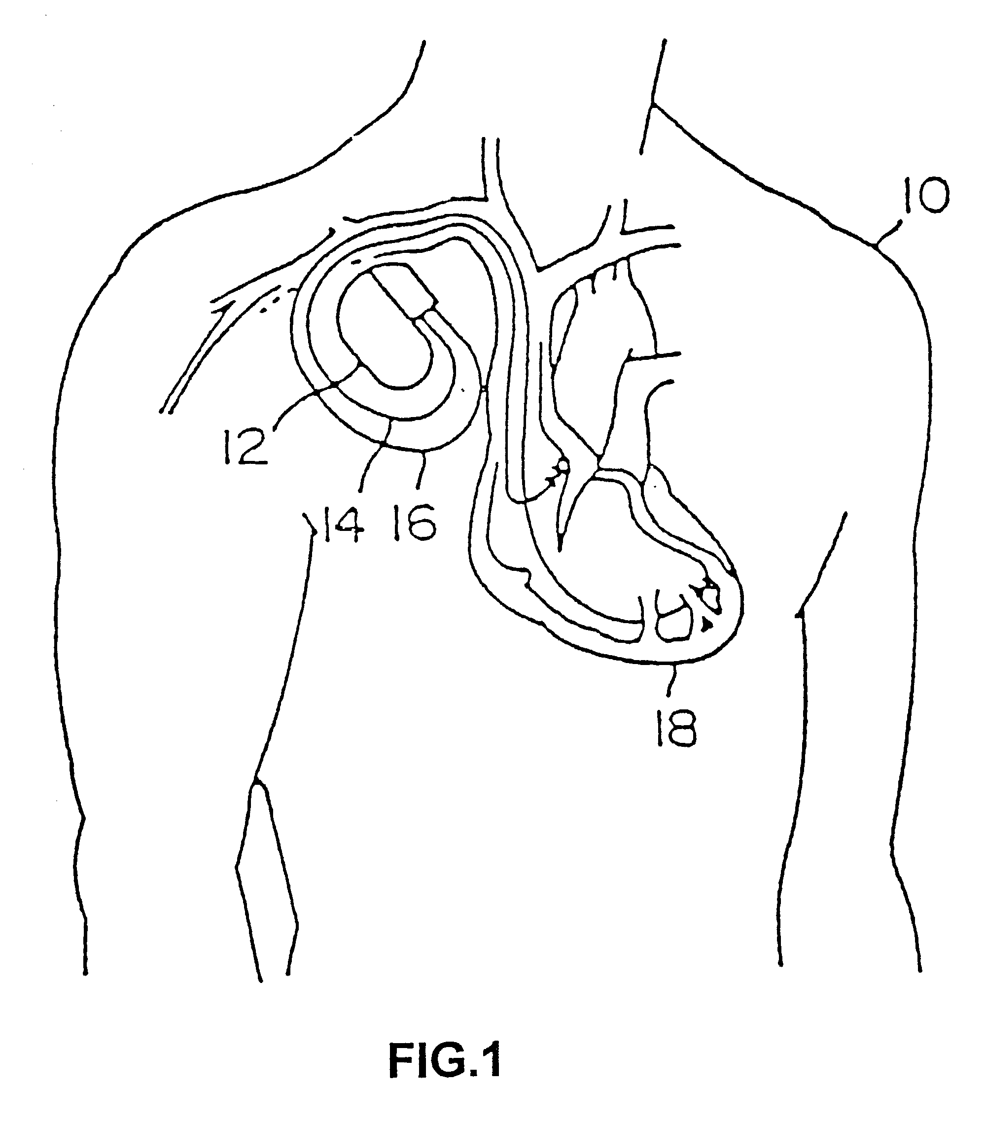 Co-extruded, multi-lumen medical lead