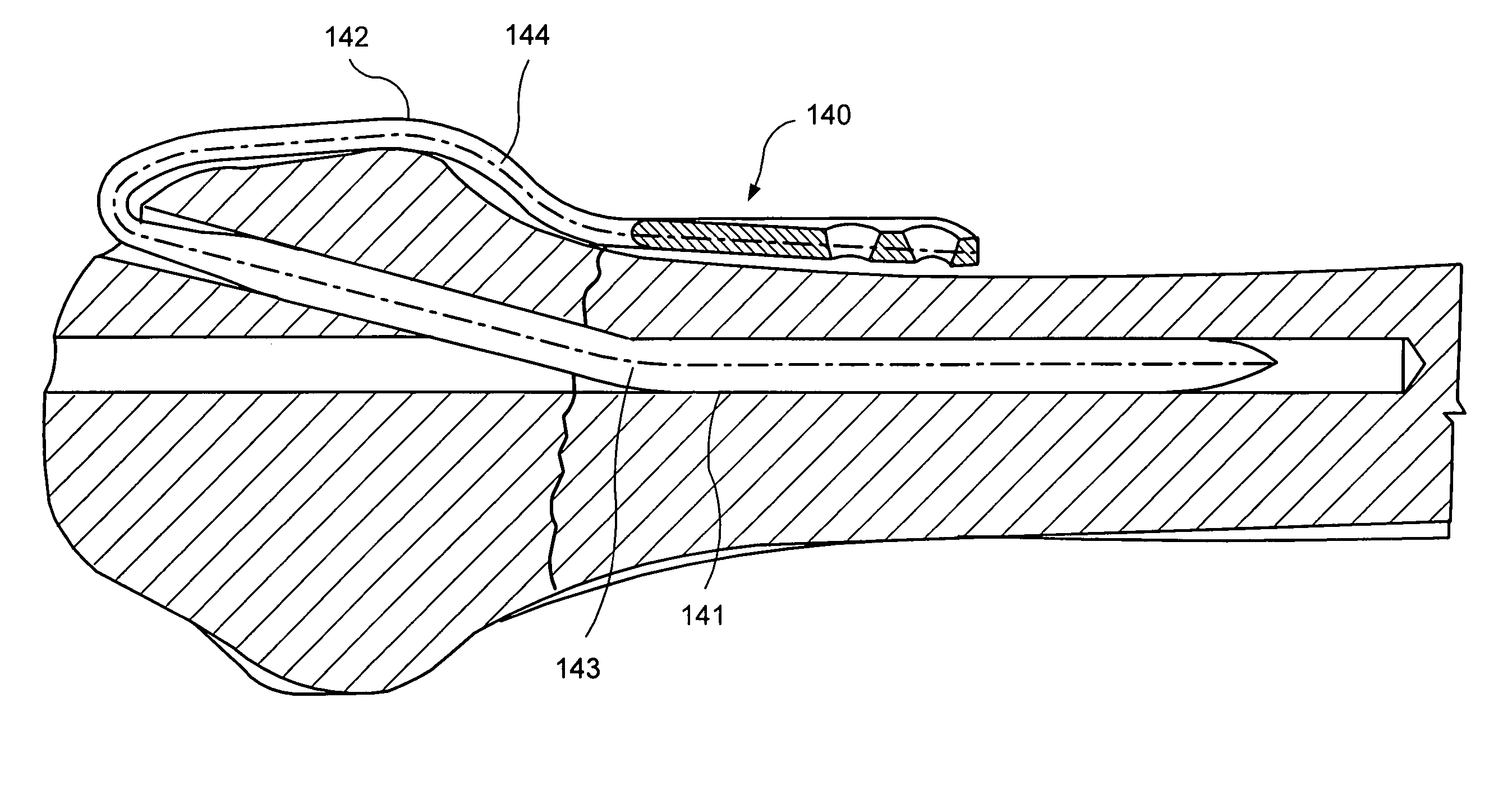 Implant device for applying compression across a fracture site