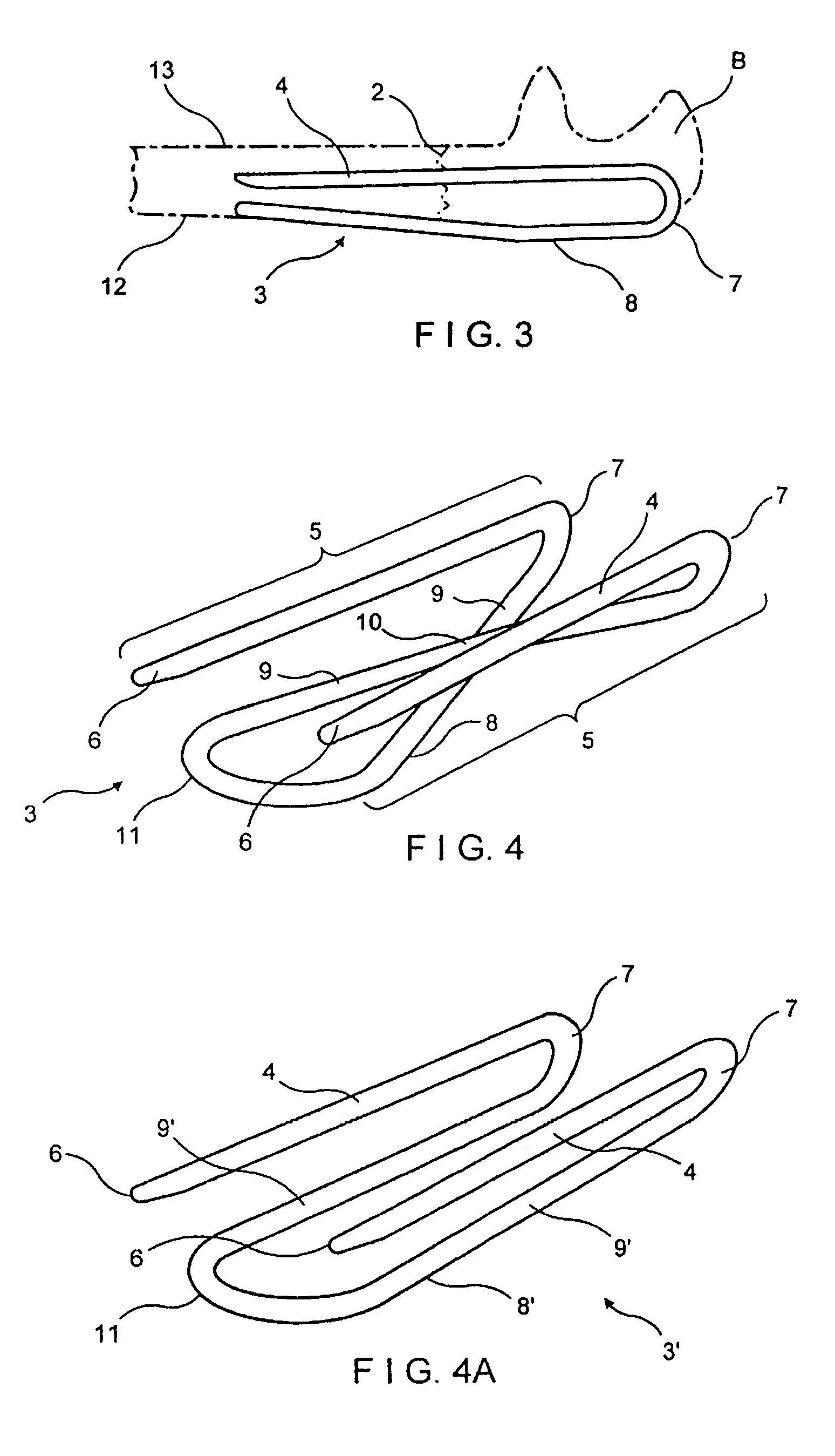 Implant device for applying compression across a fracture site