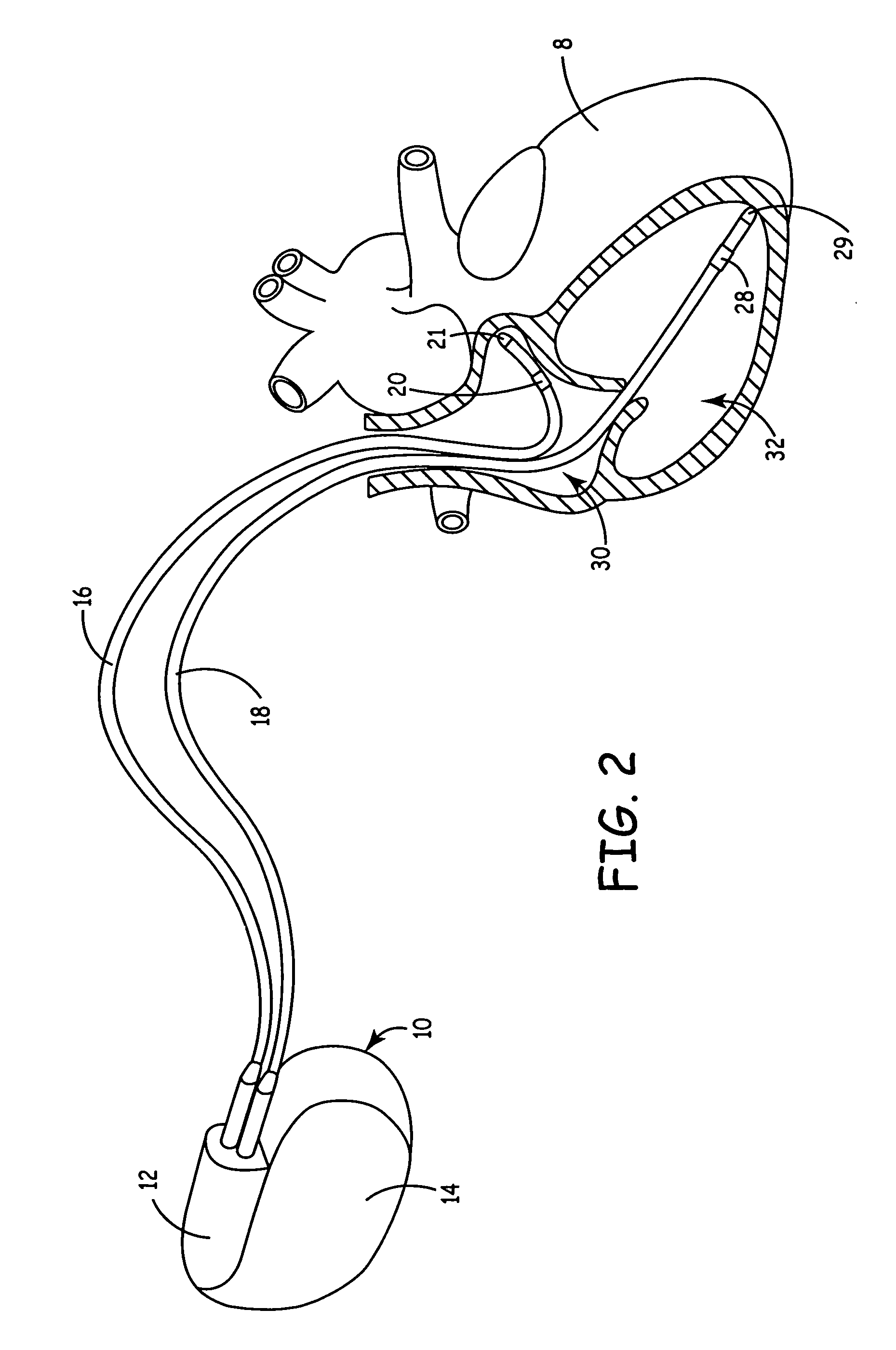 System and method for determining an effectiveness of a ventricular pacing protocol for an implantable medical device