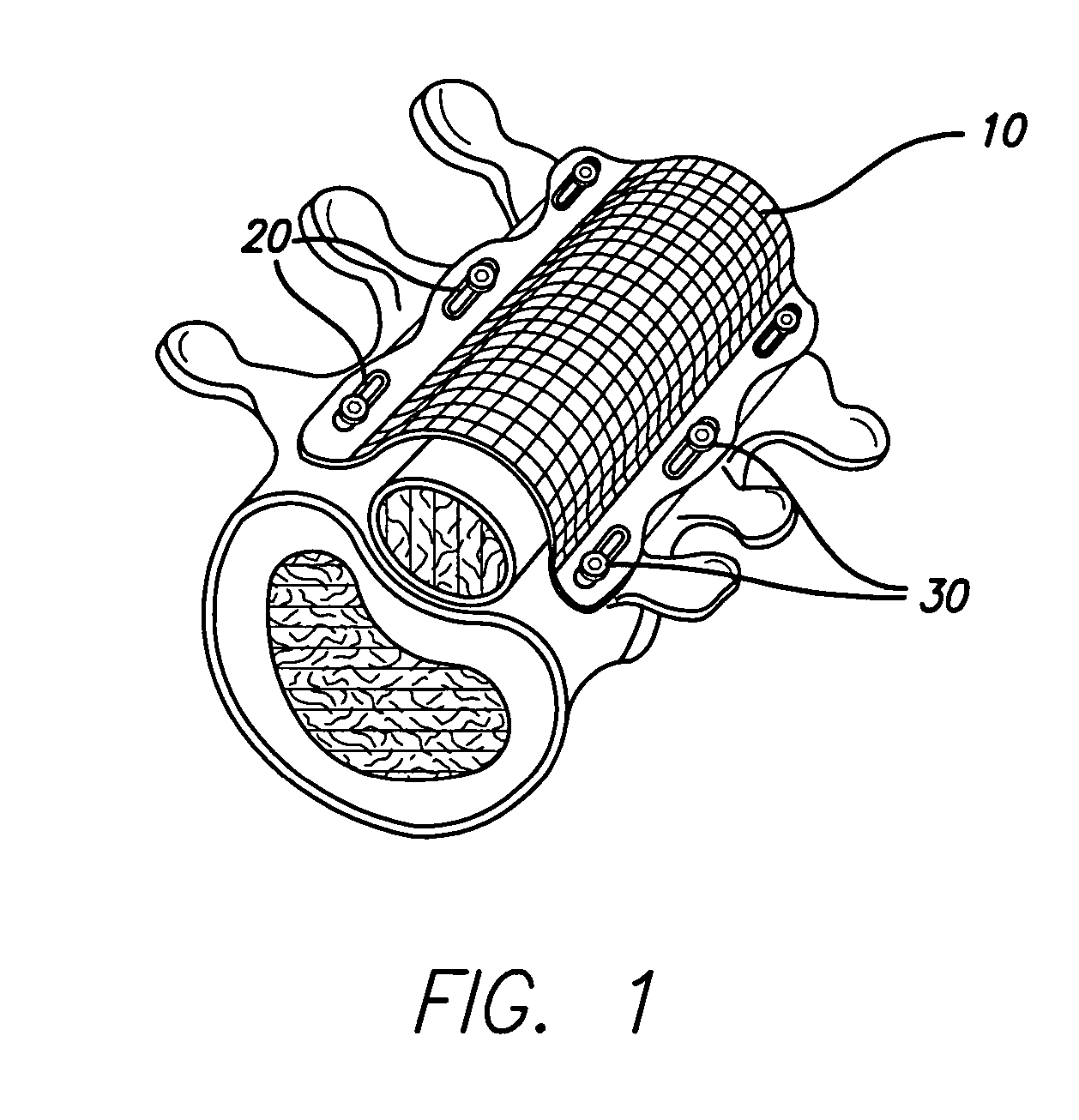 Bone anchored surgical mesh