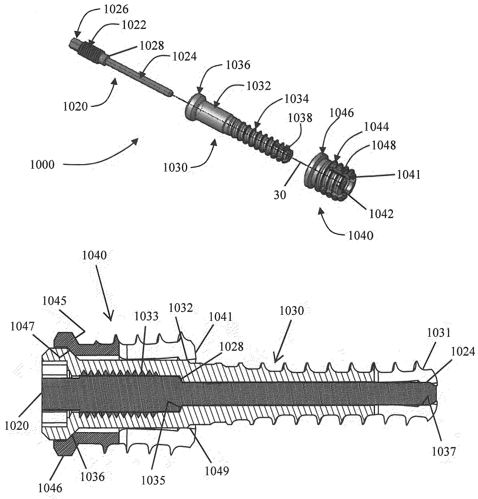 Apparatus and methods for immobilization and fusion of a synovial joint