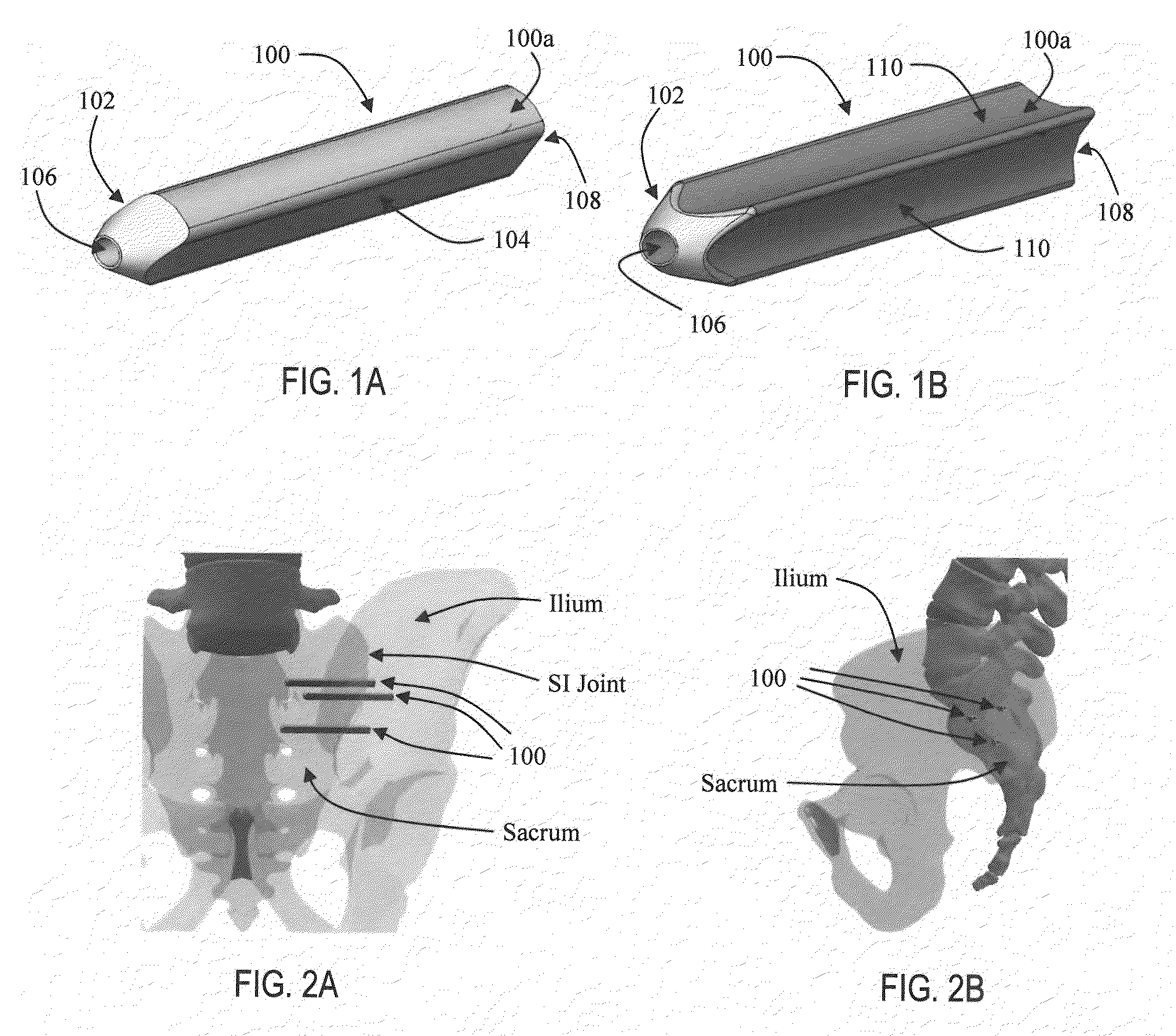 Apparatus and methods for immobilization and fusion of a synovial joint