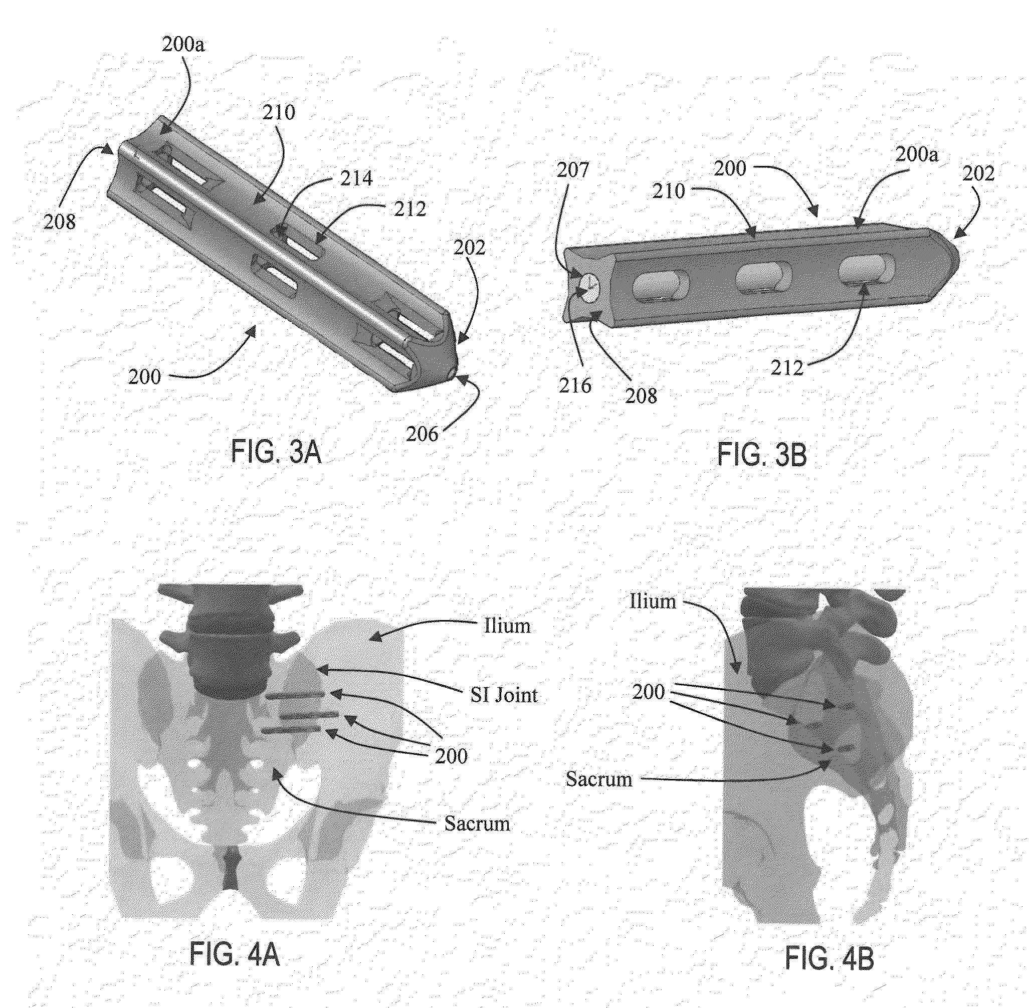 Apparatus and methods for immobilization and fusion of a synovial joint