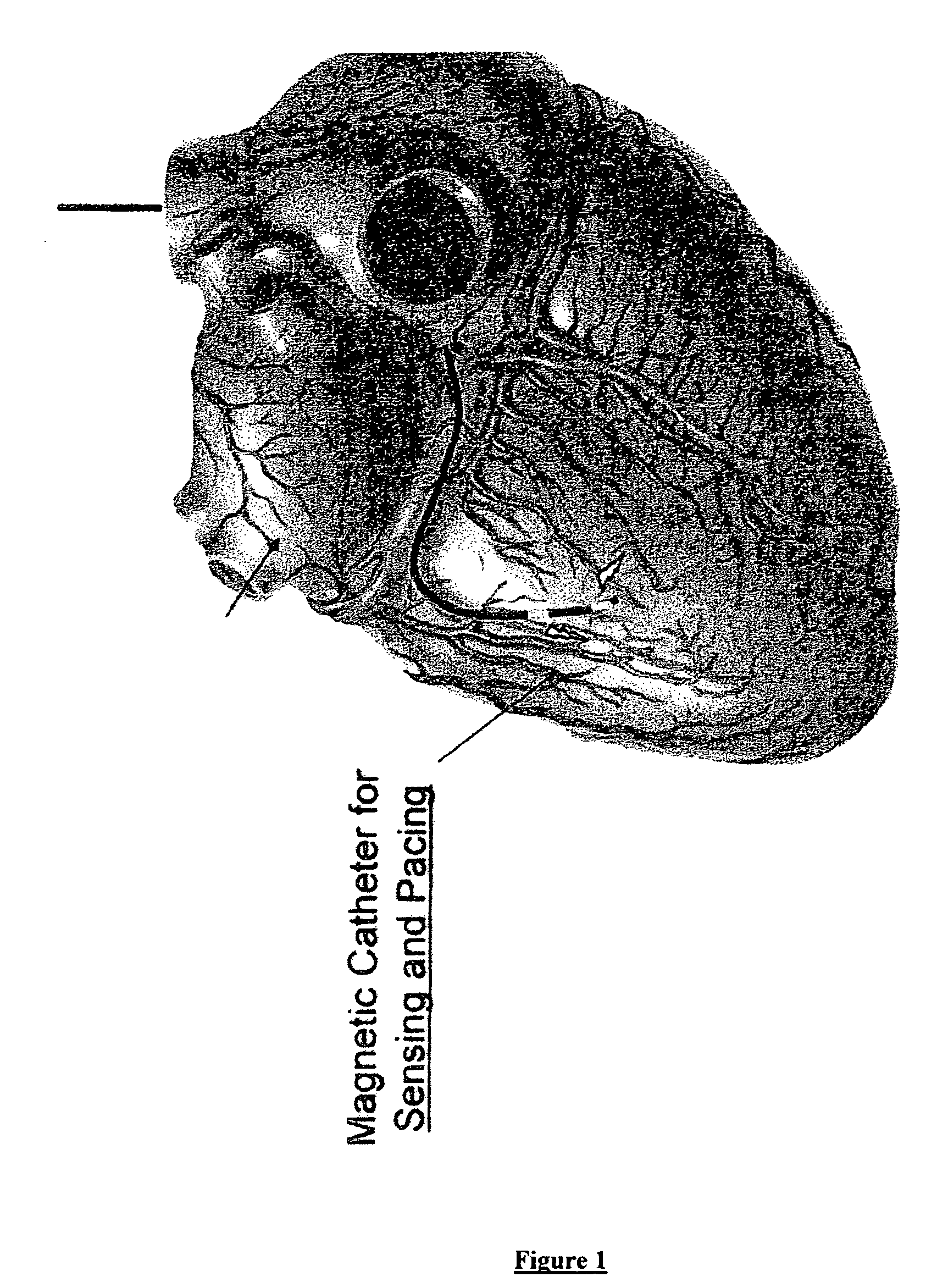 Apparatus and methods for cardiac resynchronization therapy and cardiac contractility modulation