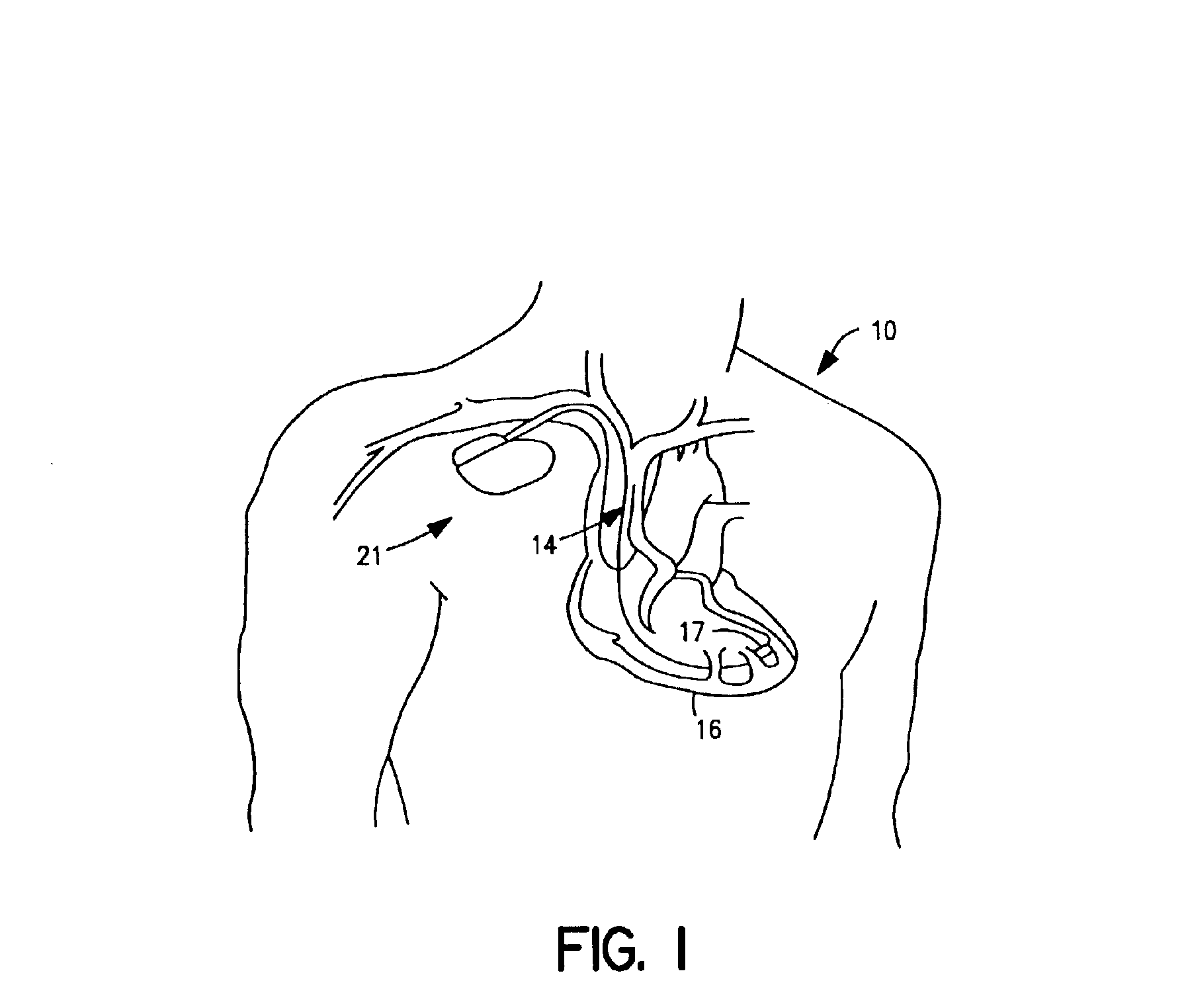 Feed through assembly for a formable flat battery