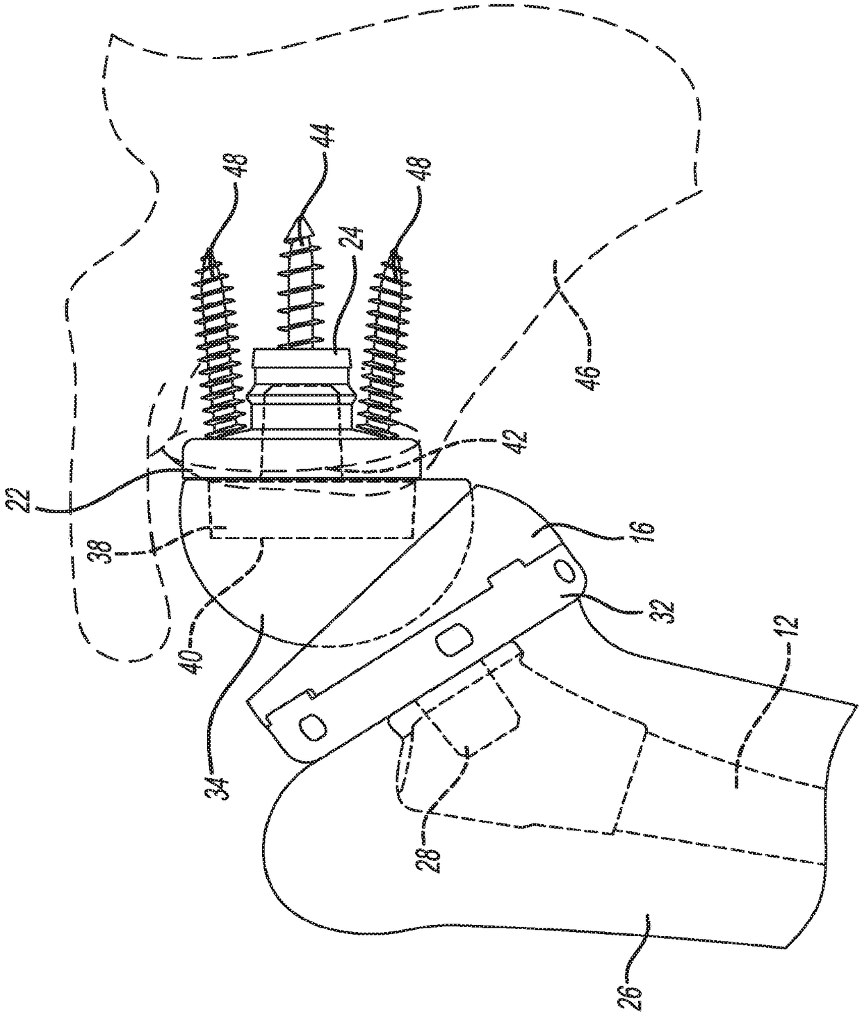 Patient-specific humeral guide designs