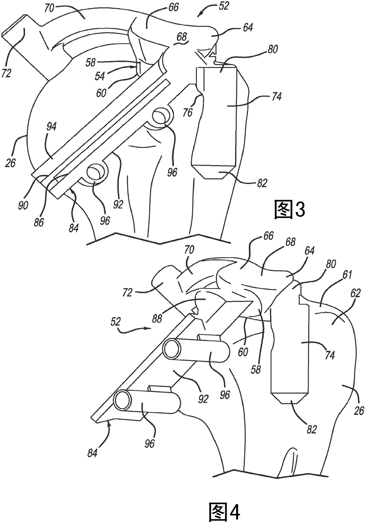 Patient-specific humeral guide designs