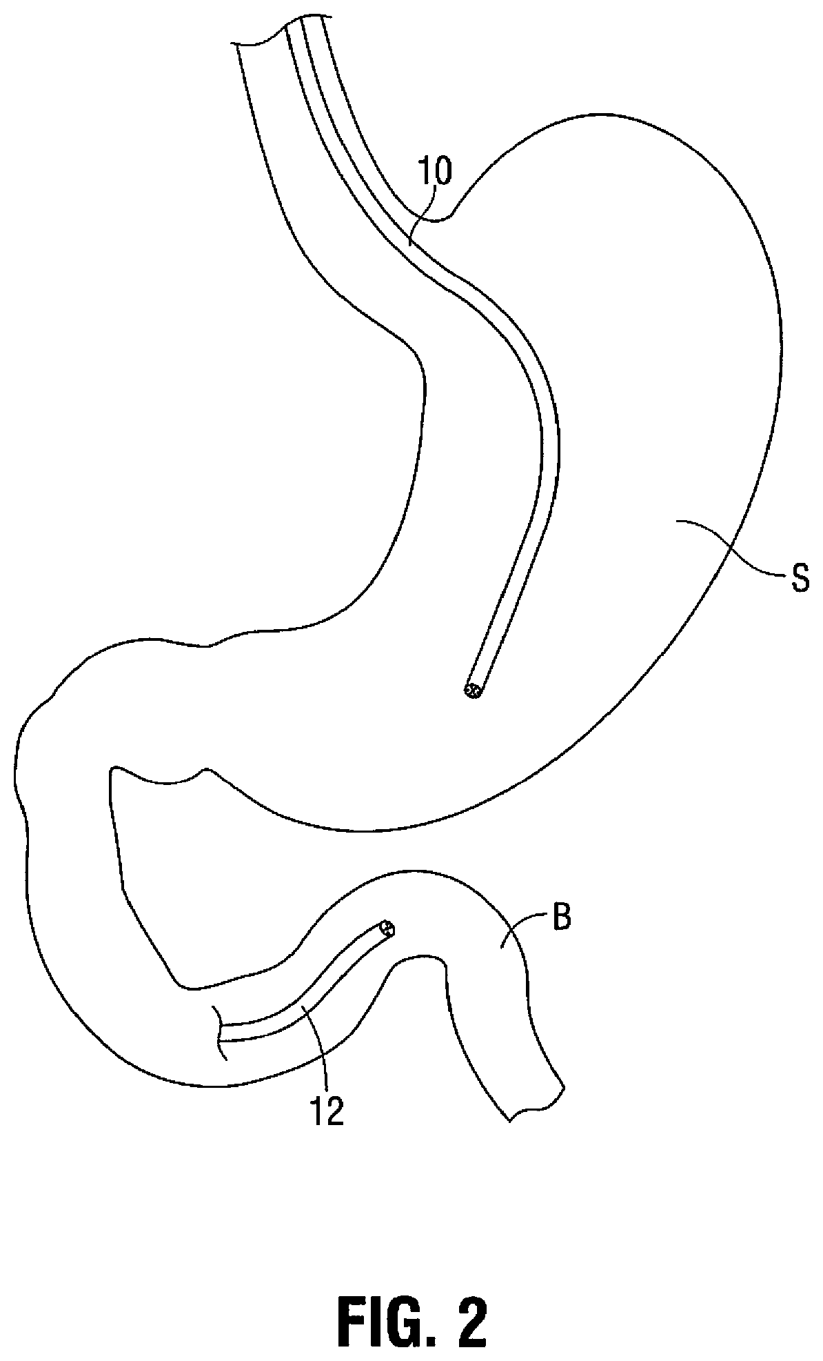 Gastric bypass system and method