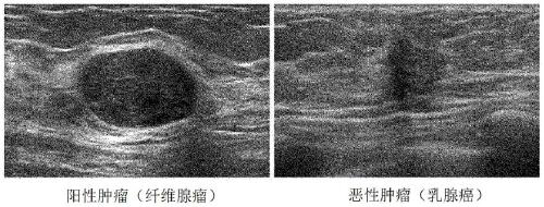 Breast cancer detection kit using saliva and breast cancer detection method using same, and fertile window detection kit using saliva and fertile window detection method using same