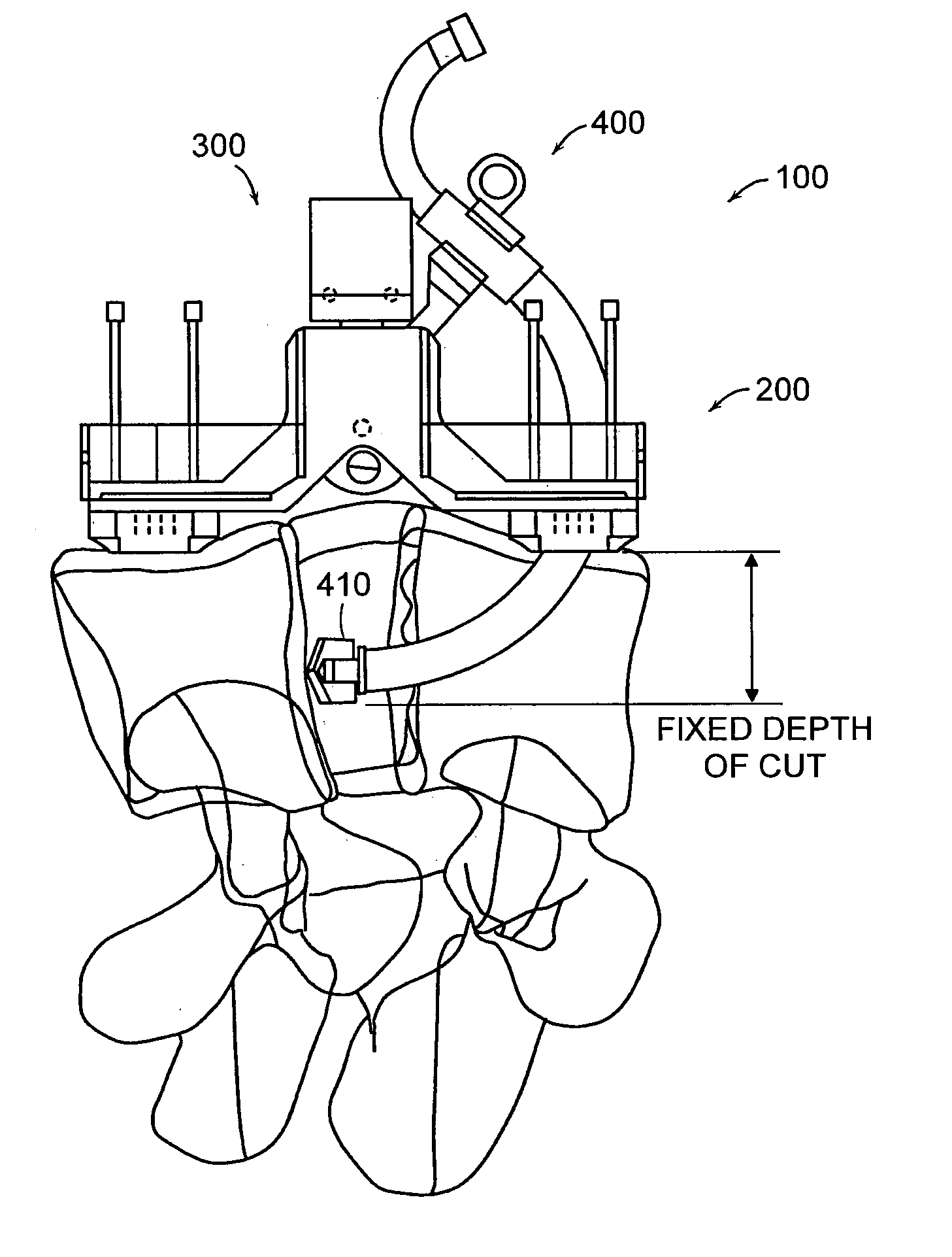 Systems, devices and apparatuses for bony fixation and disk repair and replacement and methods related thereto