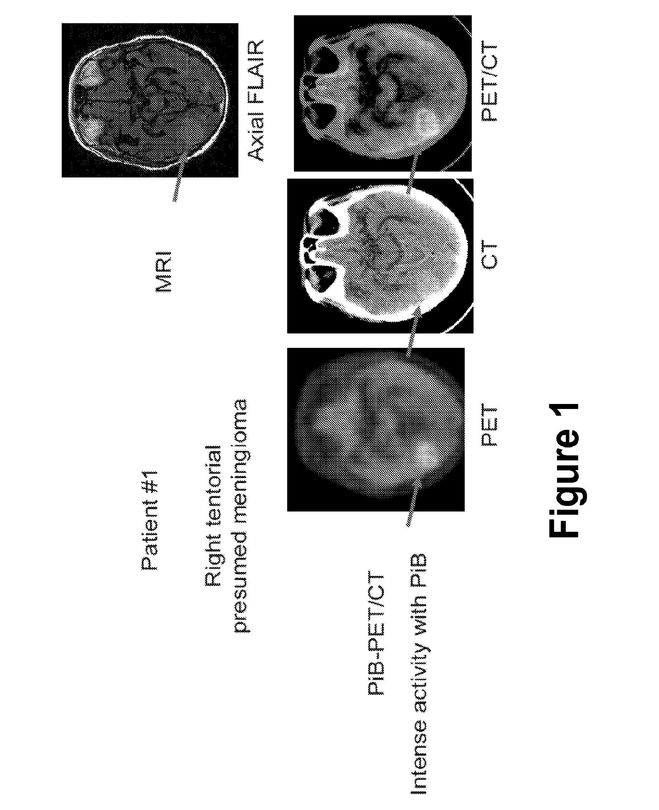 Treatment of meningiomas using phenylbenzothiazole, stilbene, biphenylalkyne, or pyridine derivatives