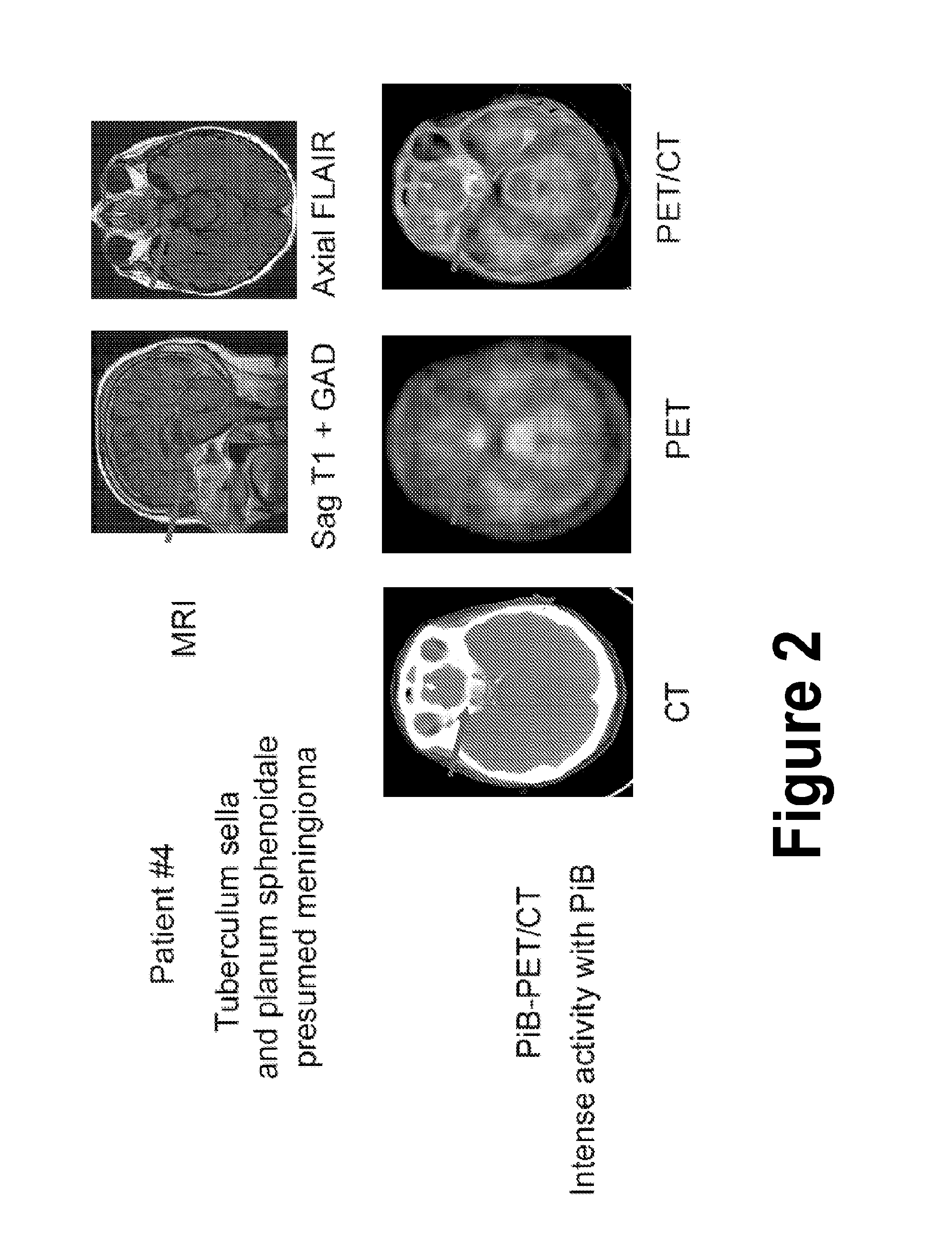 Treatment of meningiomas using phenylbenzothiazole, stilbene, biphenylalkyne, or pyridine derivatives