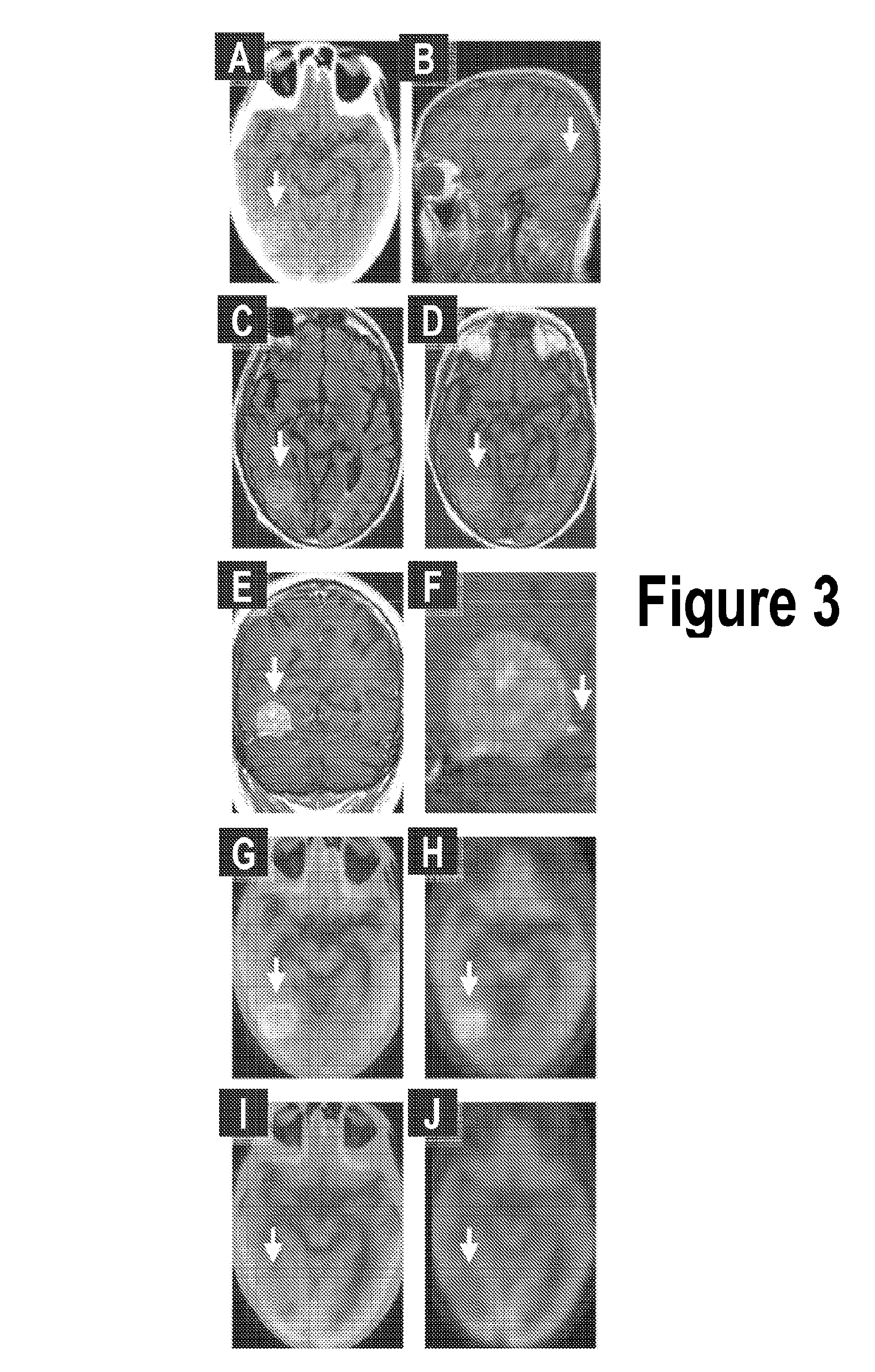 Treatment of meningiomas using phenylbenzothiazole, stilbene, biphenylalkyne, or pyridine derivatives