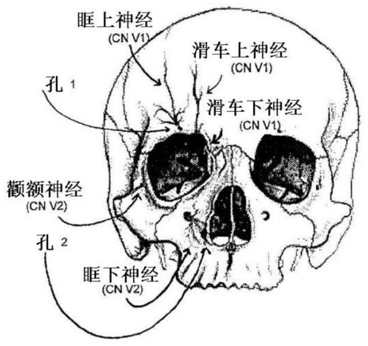 Pulse generator for trigeminal nerve stimulation