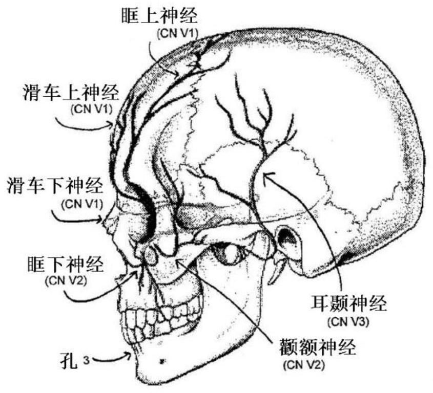 Pulse generator for trigeminal nerve stimulation