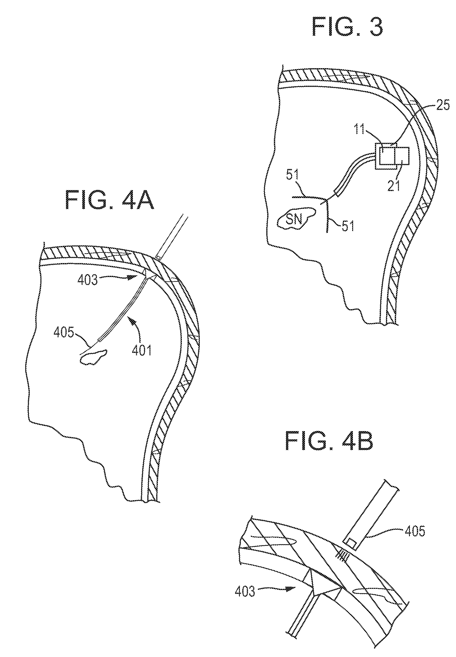 Endoscopic delivery of red/nir light to the substantia nigra to treat parkinson's disease