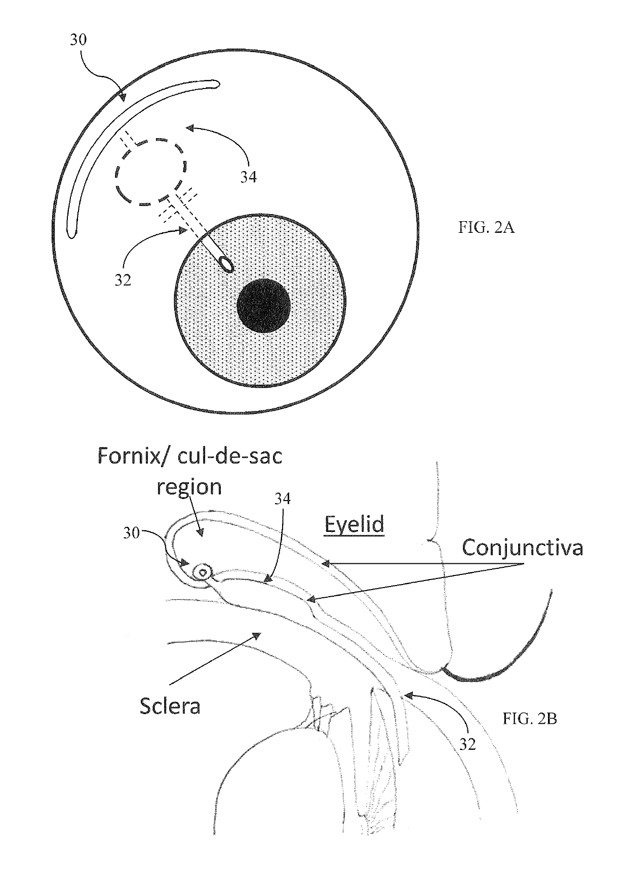 Method and apparatus for reducing intraocular pressure