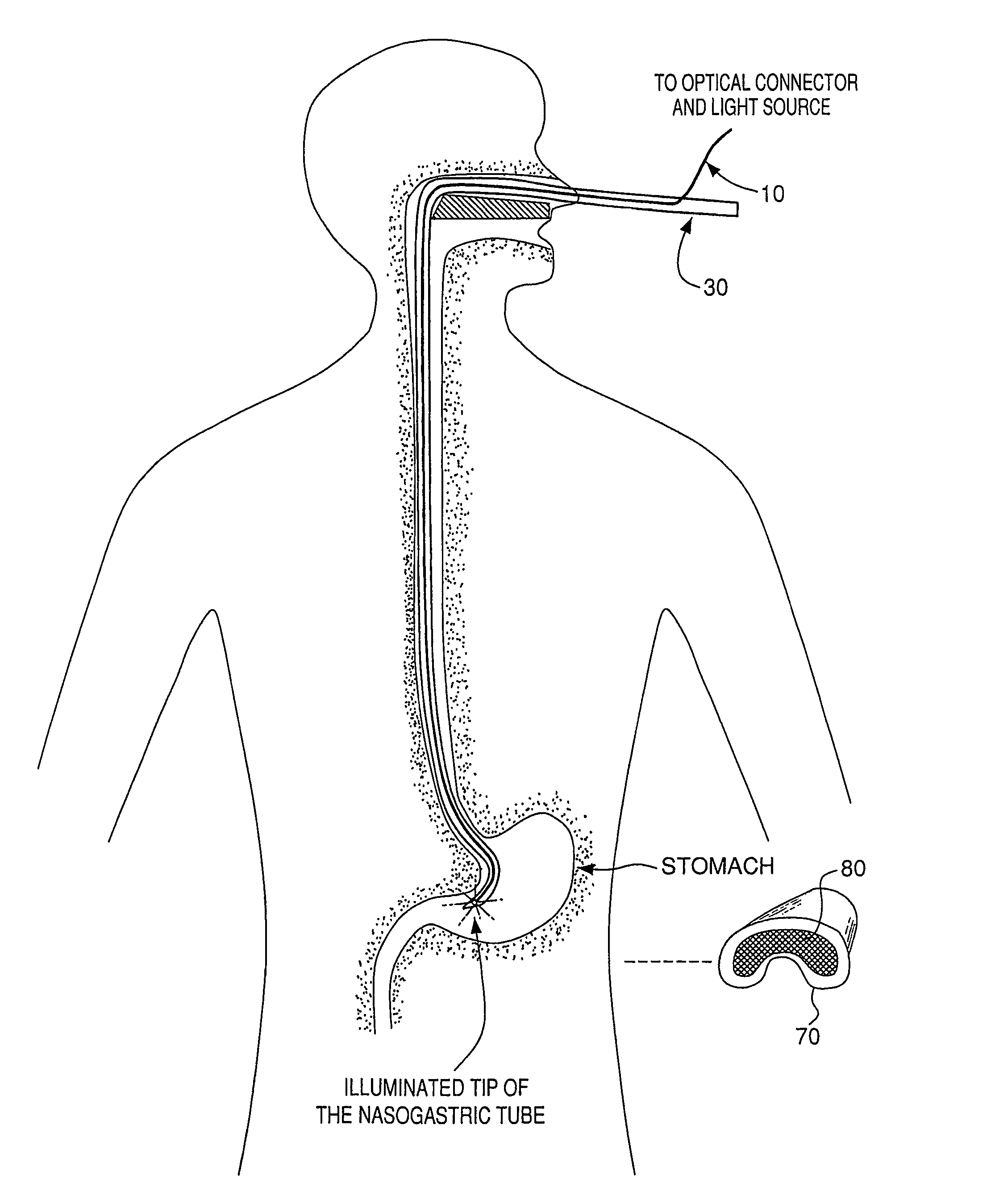 Optical guidance system for invasive catheter placement